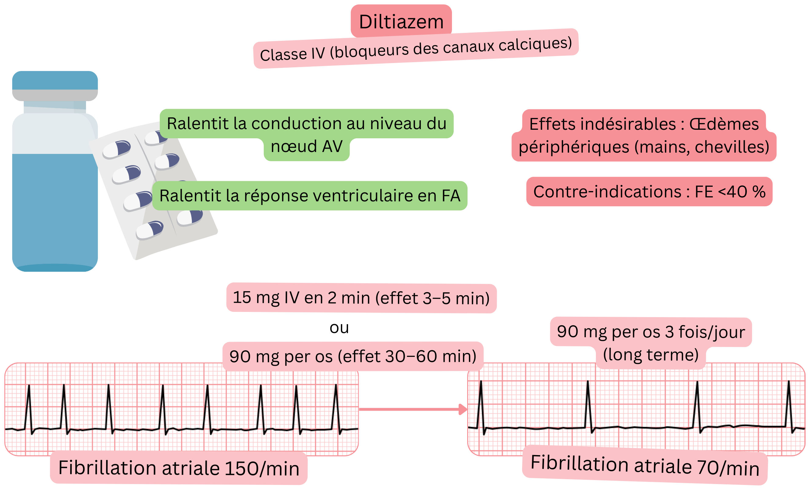 Schéma de l’effet du diltiazem comme antiarythmique de classe IV illustrant le ralentissement de la conduction à travers le nœud auriculoventriculaire et la diminution de la fréquence ventriculaire lors de la fibrillation auriculaire.
