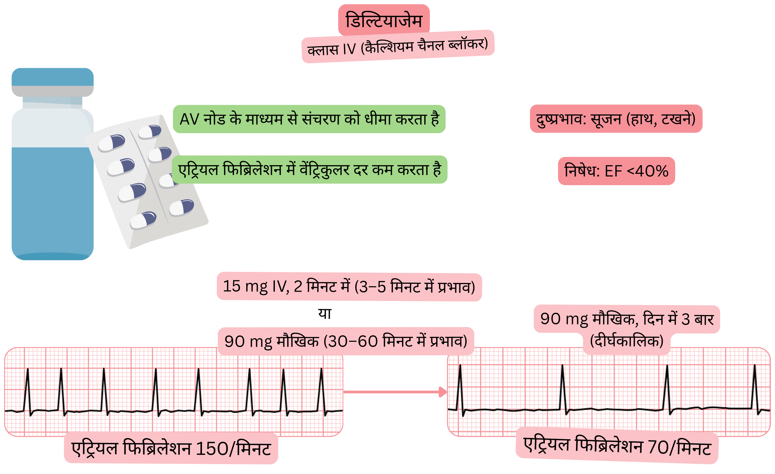 क्लास IV एंटीएरिदमिक के रूप में डिल्टियाज़ेम के प्रभाव का आरेख, जिसमें एट्रियोवेंट्रिकुलर नोड के माध्यम से संचरण के धीमे होने और एट्रियल फिब्रिलेशन में वेंट्रिकुलर दर में कमी को दर्शाया गया है।