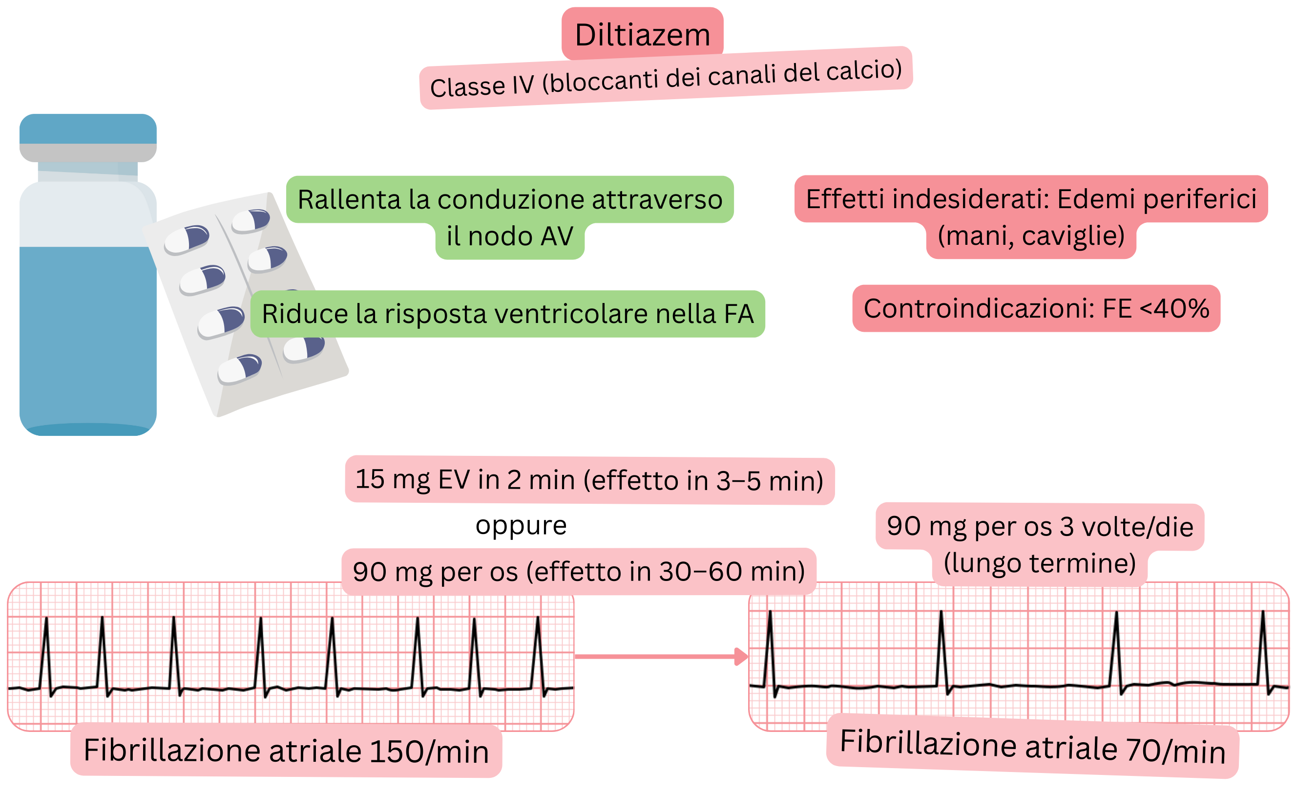 Schema dell’effetto del diltiazem come antiaritmico di classe IV che illustra il rallentamento della conduzione attraverso il nodo atrioventricolare e la riduzione della frequenza ventricolare nella fibrillazione atriale.