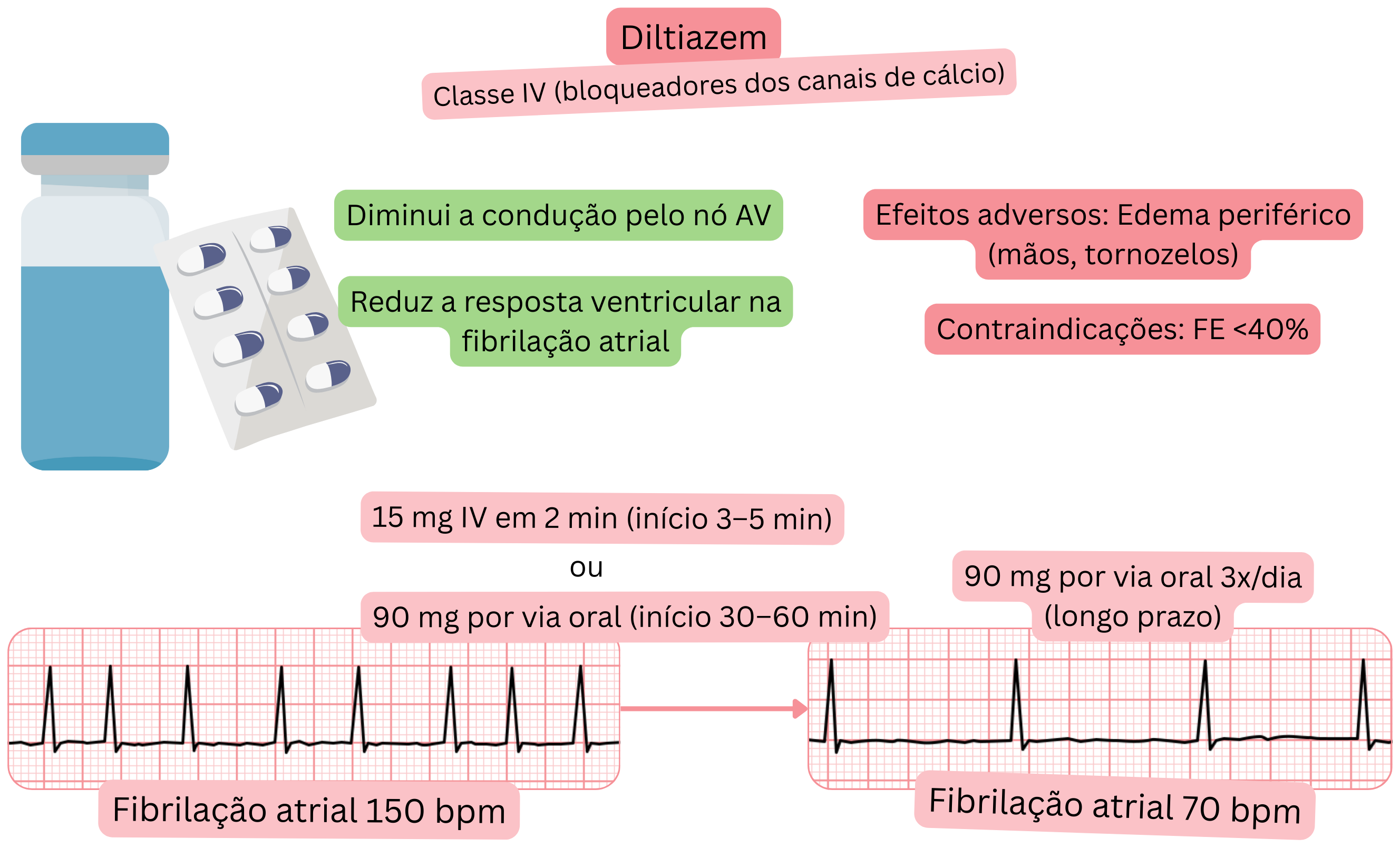 Esquema do efeito do diltiazem como antiarrítmico de classe IV demonstrando lentificação da condução pelo nó atrioventricular e redução da frequência ventricular na fibrilação atrial.