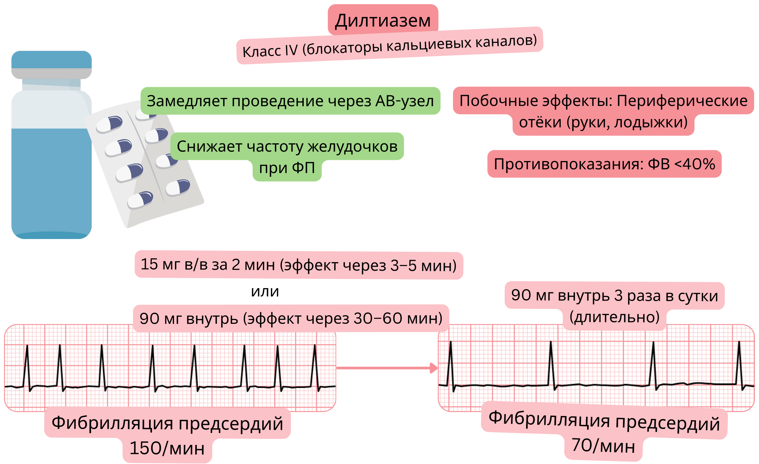 Схема действия дилтиазема как антиаритмического препарата класса IV, демонстрирующая замедление проведения через атриовентрикулярный узел и снижение желудочковой частоты при фибрилляции предсердий.