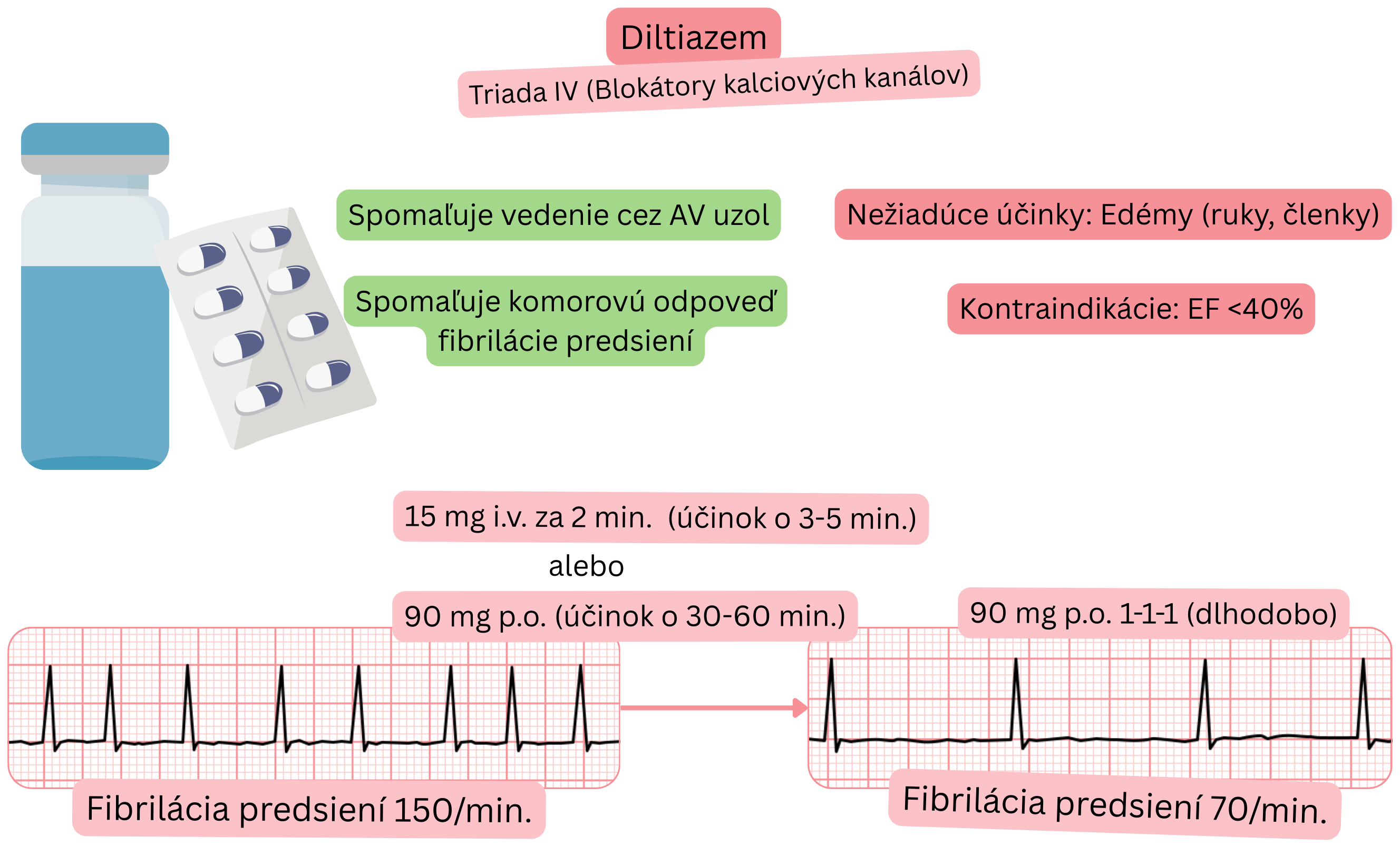 Schéma účinku diltiazemu ako antiarytmika triedy IV znázorňujúca spomalenie vedenia cez atrioventrikulárny uzol a zníženie komorovej frekvencie pri fibrilácii predsiení.