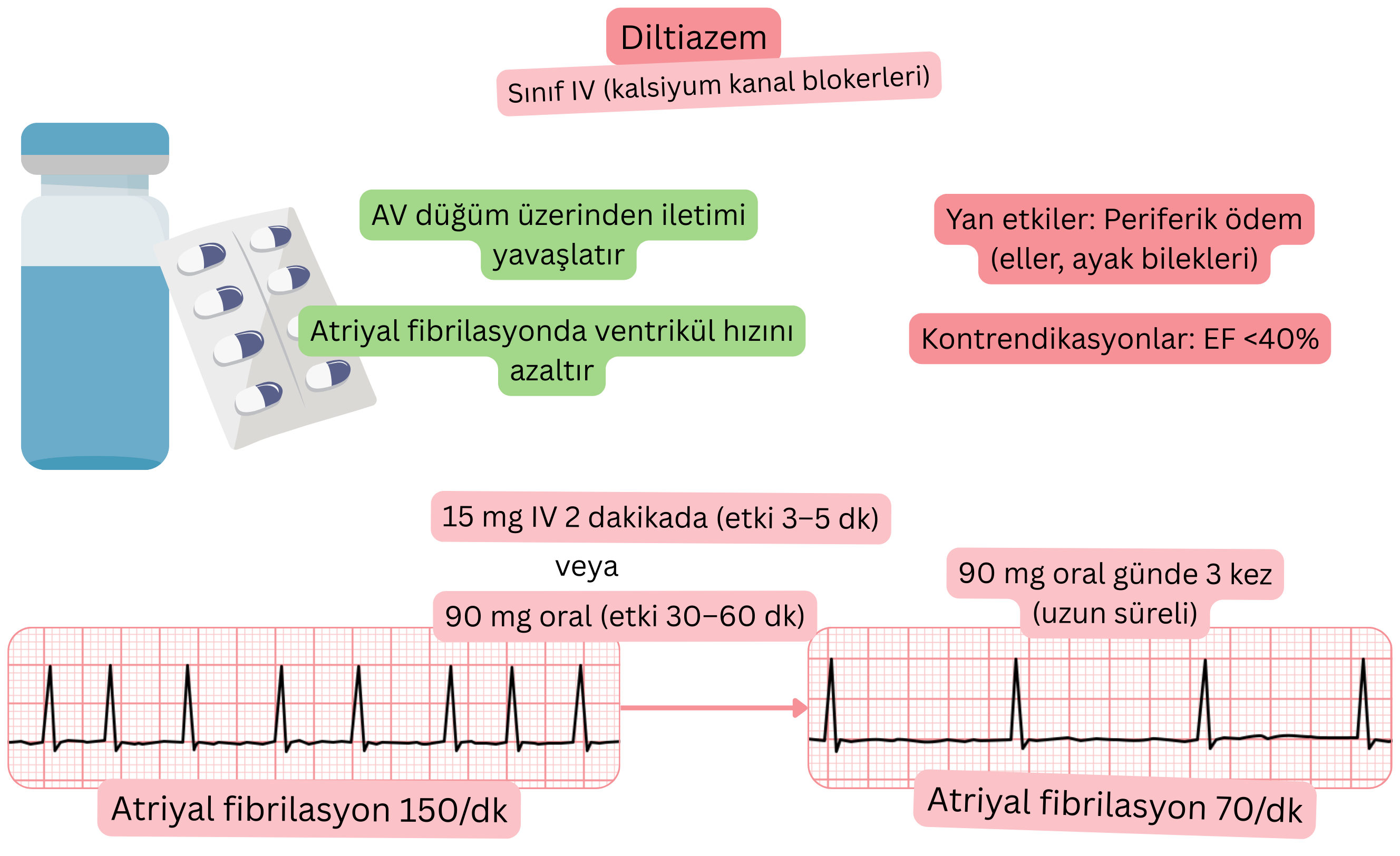 IV sınıfı antiaritmik olarak diltiazemin etkisini gösteren şema; atriyoventriküler düğümden iletimin yavaşlamasını ve atriyal fibrilasyonda ventrikül hızının azalmasını göstermektedir.