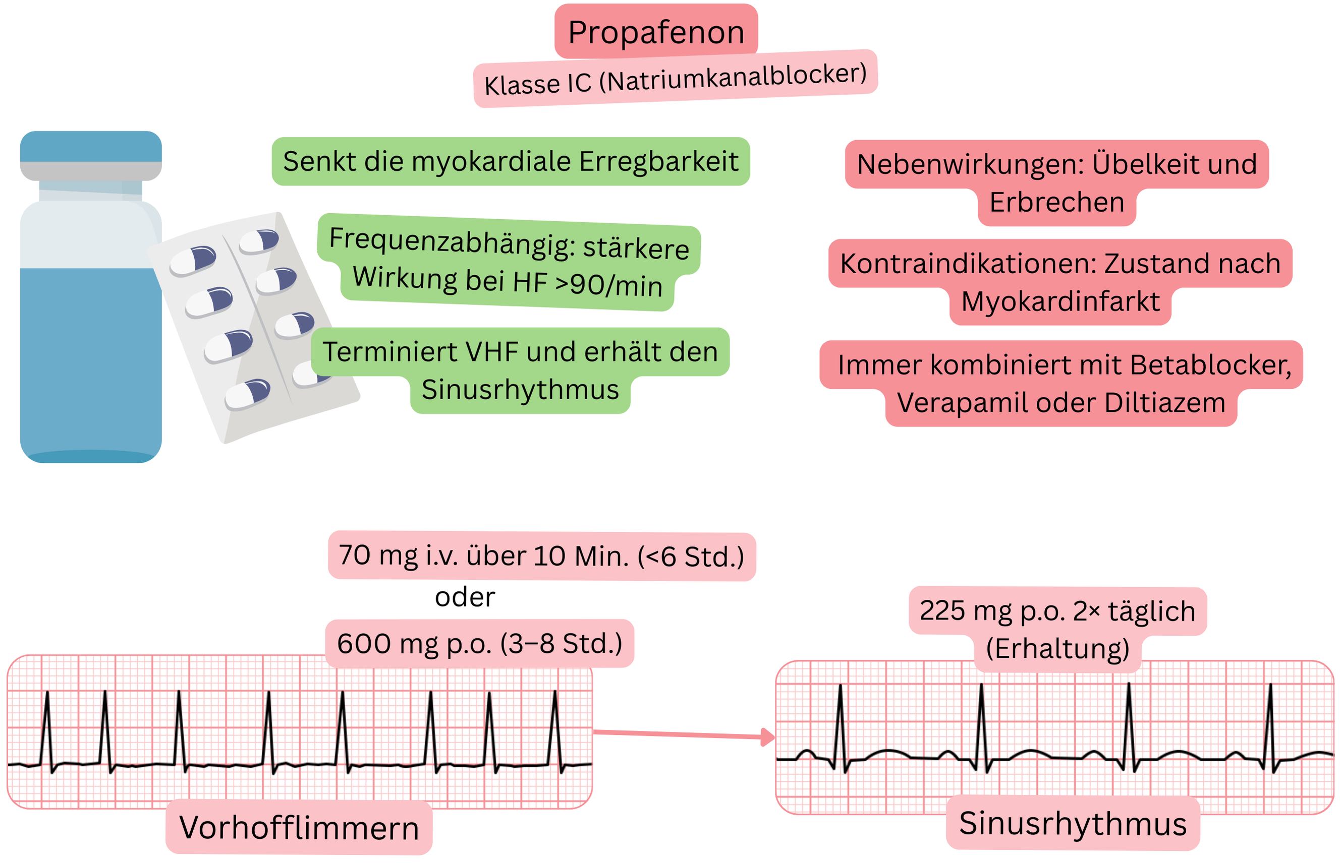 Schema der Wirkung von Propafenon als Antiarrhythmikum der Klasse IC mit Darstellung der use-abhängigen Blockade von Natriumkanälen, der Reduktion der myokardialen Erregbarkeit und der pharmakologischen Kardioversion von Vorhofflimmern in den Sinusrhythmus.