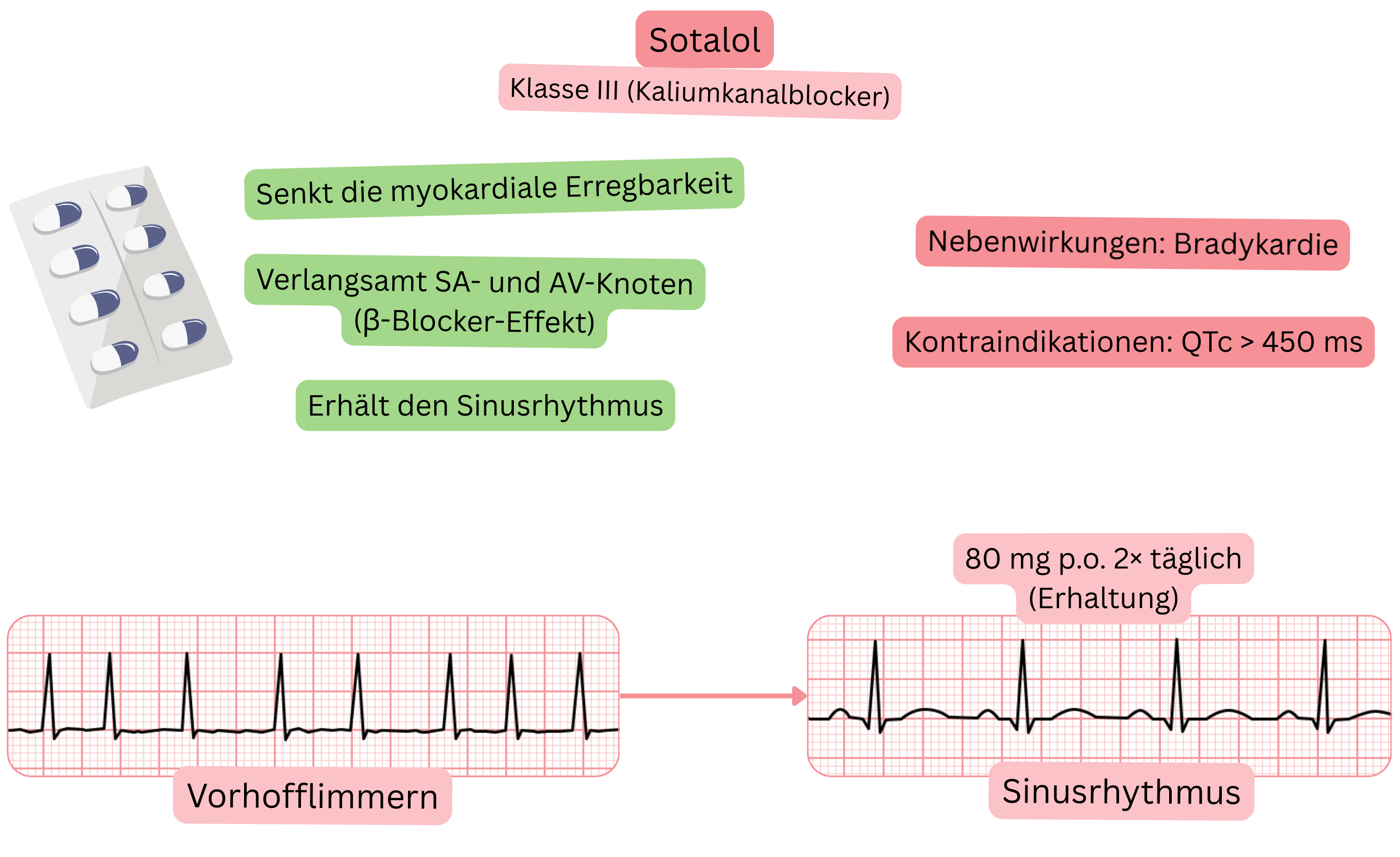 Schema der Wirkung von Sotalol als Antiarrhythmikum der Klasse III mit Darstellung der Blockade von Kaliumkanälen, Verlangsamung des Sinus- und AV-Knotens, Reduktion der myokardialen Erregbarkeit und Aufrechterhaltung des Sinusrhythmus bei Vorhofflimmern.