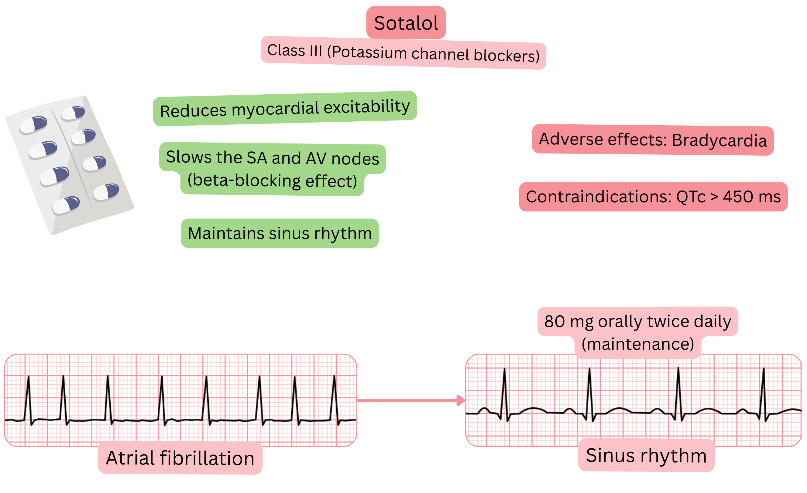 Diagram of the effect of sotalol as a class III antiarrhythmic illustrating potassium channel blockade with slowing of the SA and AV nodes, reduced myocardial excitability, and maintenance of sinus rhythm in atrial fibrillation.