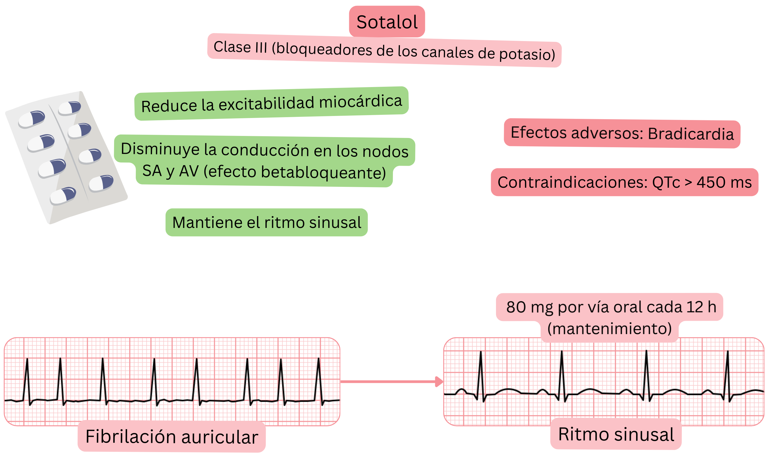 Esquema del efecto del sotalol como antiarrítmico de clase III que muestra el bloqueo de los canales de potasio con enlentecimiento del nodo SA y AV, reducción de la excitabilidad miocárdica y mantenimiento del ritmo sinusal en la fibrilación auricular.
