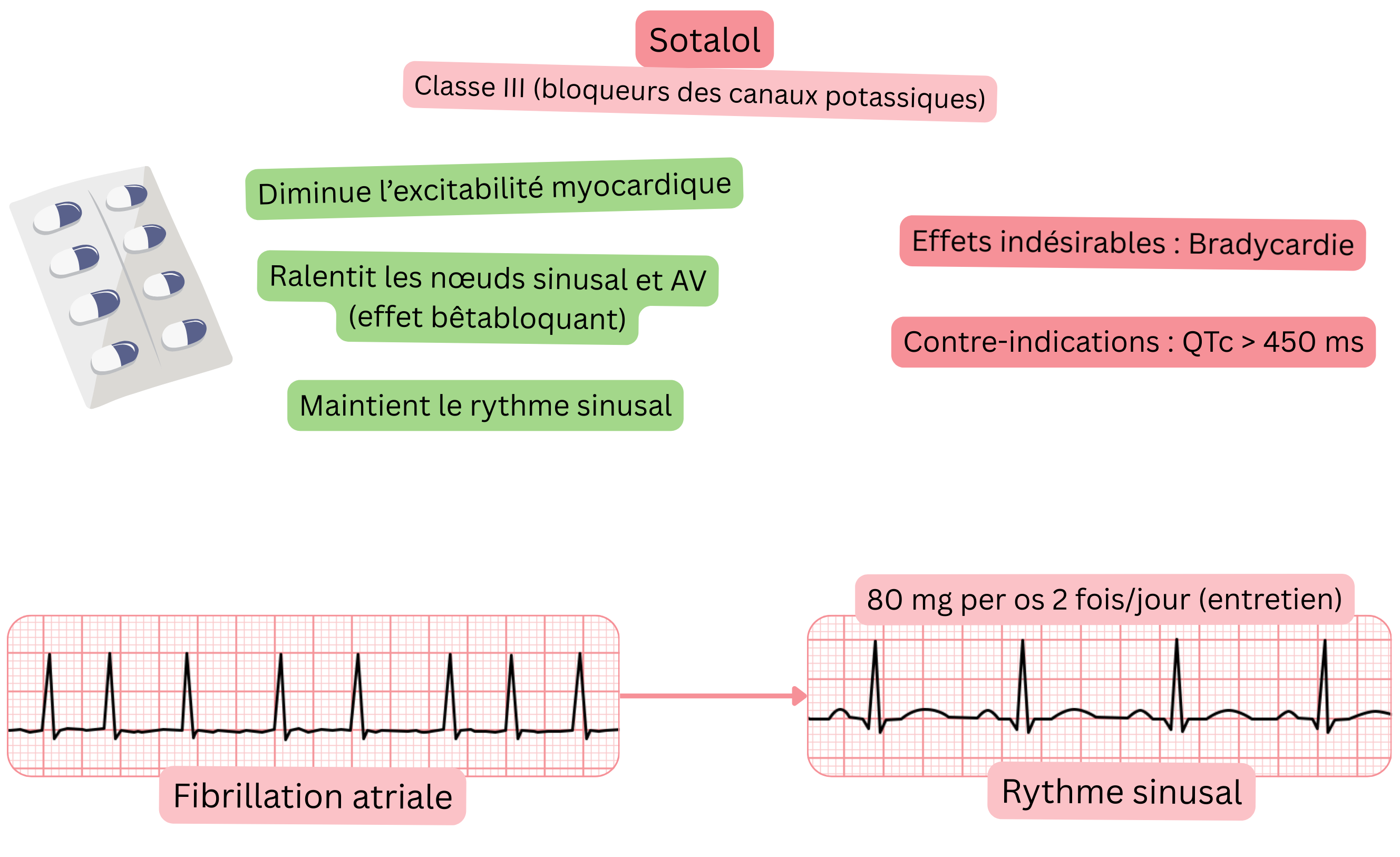 Schéma de l’effet du sotalol comme antiarythmique de classe III illustrant le blocage des canaux potassiques avec ralentissement des nœuds sinusal et auriculoventriculaire, diminution de l’excitabilité myocardique et maintien du rythme sinusal en fibrillation auriculaire.