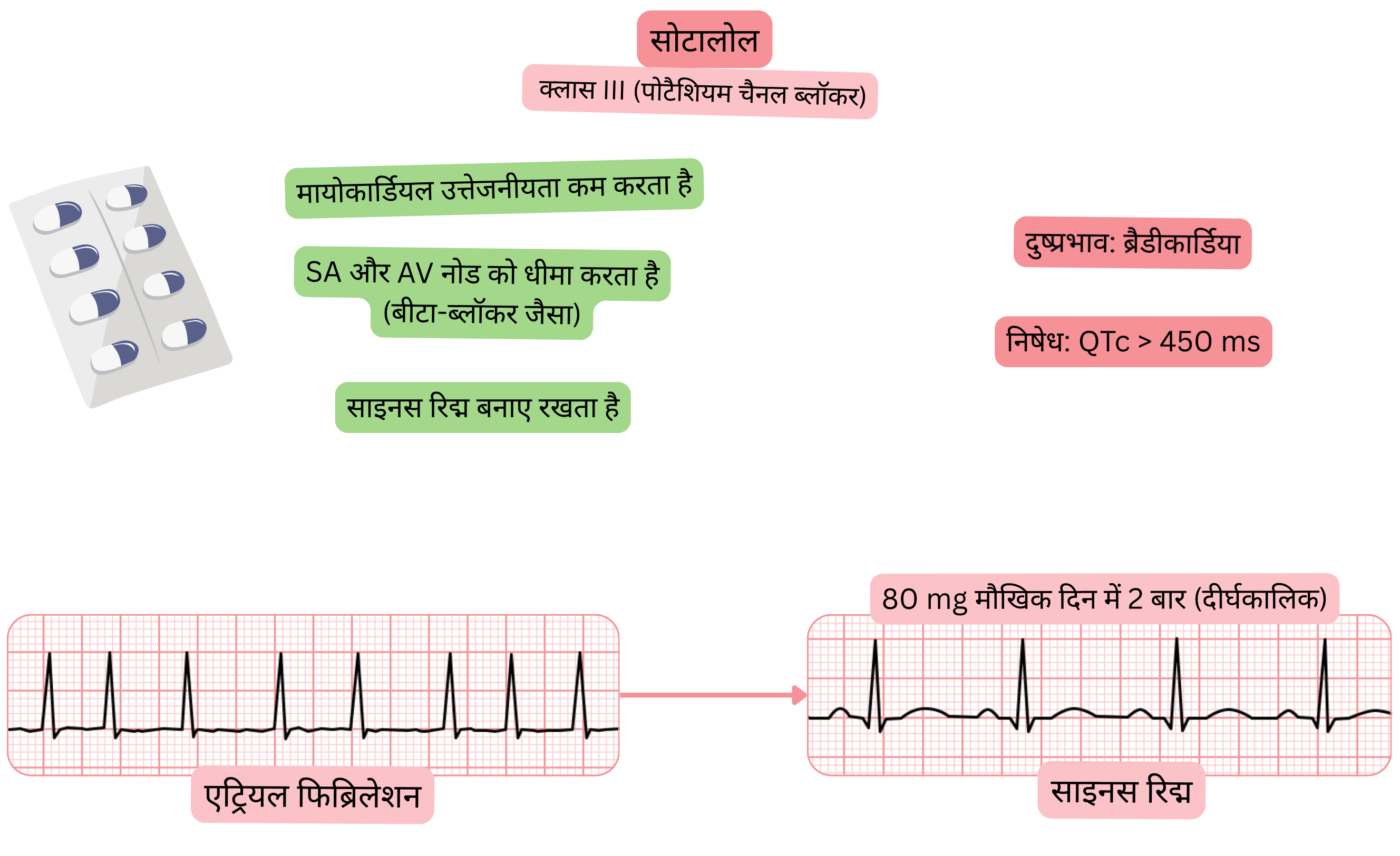 क्लास III एंटीएरिदमिक के रूप में सोटालोल के प्रभाव का आरेख, जिसमें पोटैशियम चैनल ब्लॉकेड, SA और AV नोड की गति में कमी, मायोकार्डियल उत्तेजनीयता में कमी तथा एट्रियल फिब्रिलेशन में साइनस रिद्म का संरक्षण दर्शाया गया है।