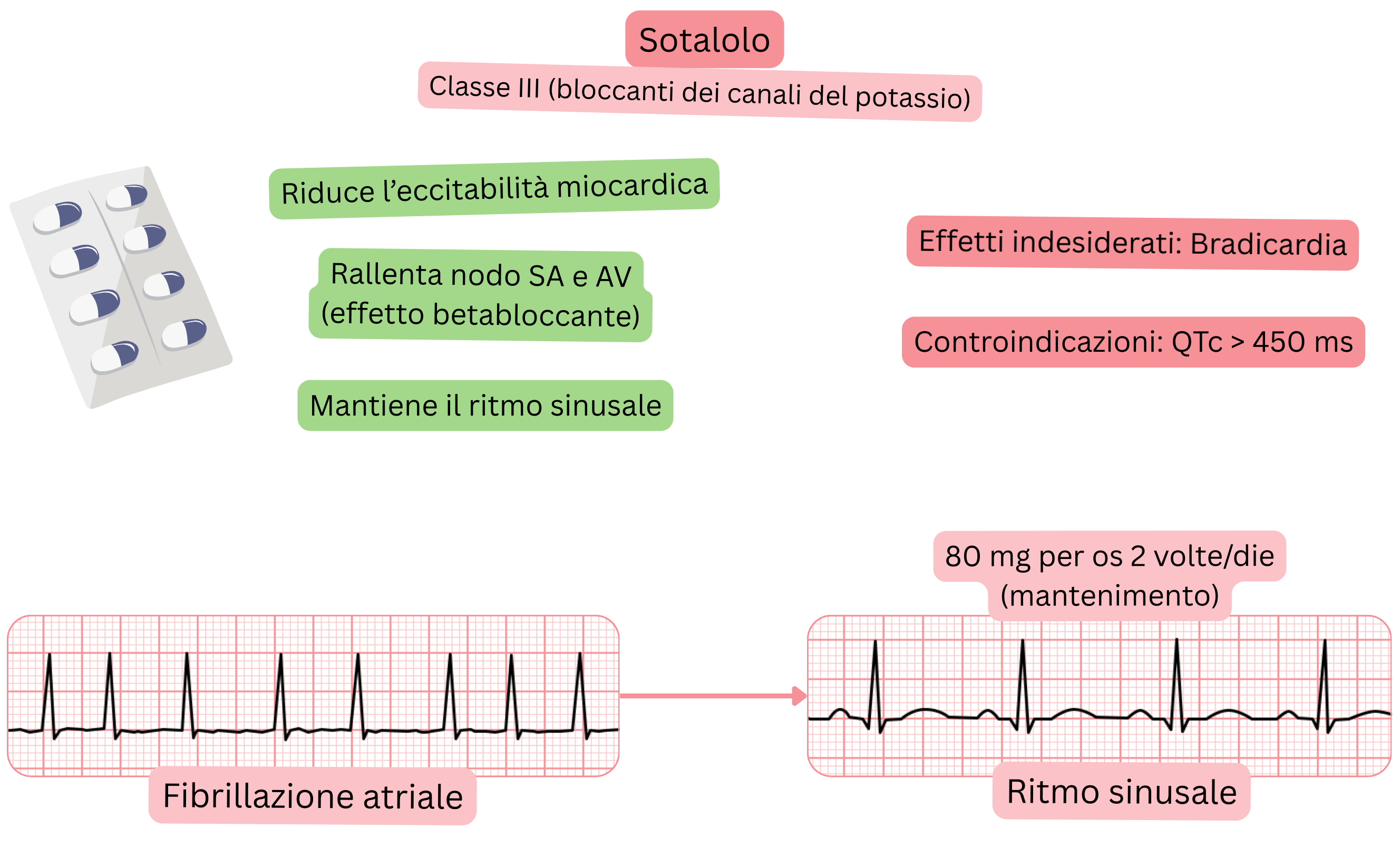 Schema dell’effetto del sotalolo come antiaritmico di classe III che illustra il blocco dei canali del potassio con rallentamento del nodo senoatriale e atrioventricolare, riduzione dell’eccitabilità miocardica e mantenimento del ritmo sinusale nella fibrillazione atriale.