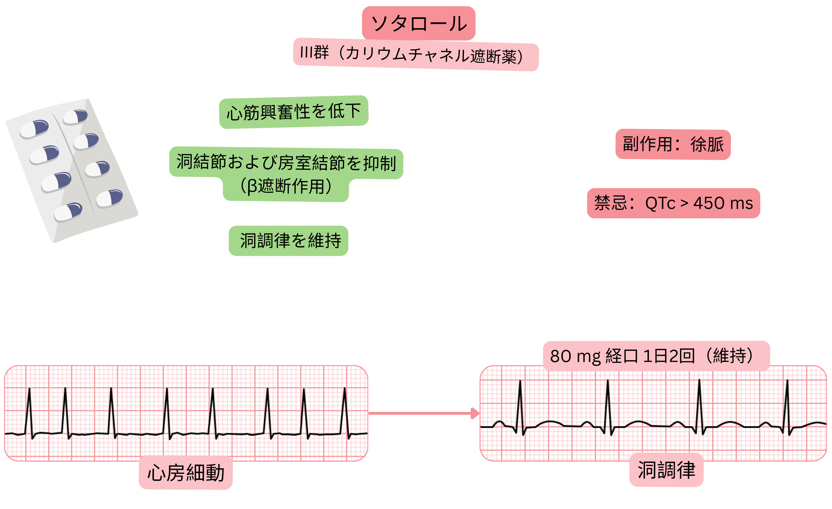 III群抗不整脈薬としてのソタロールの作用を示す模式図で、カリウムチャネル遮断による洞結節および房室結節の抑制、心筋興奮性低下、および心房細動における洞調律維持を示す。