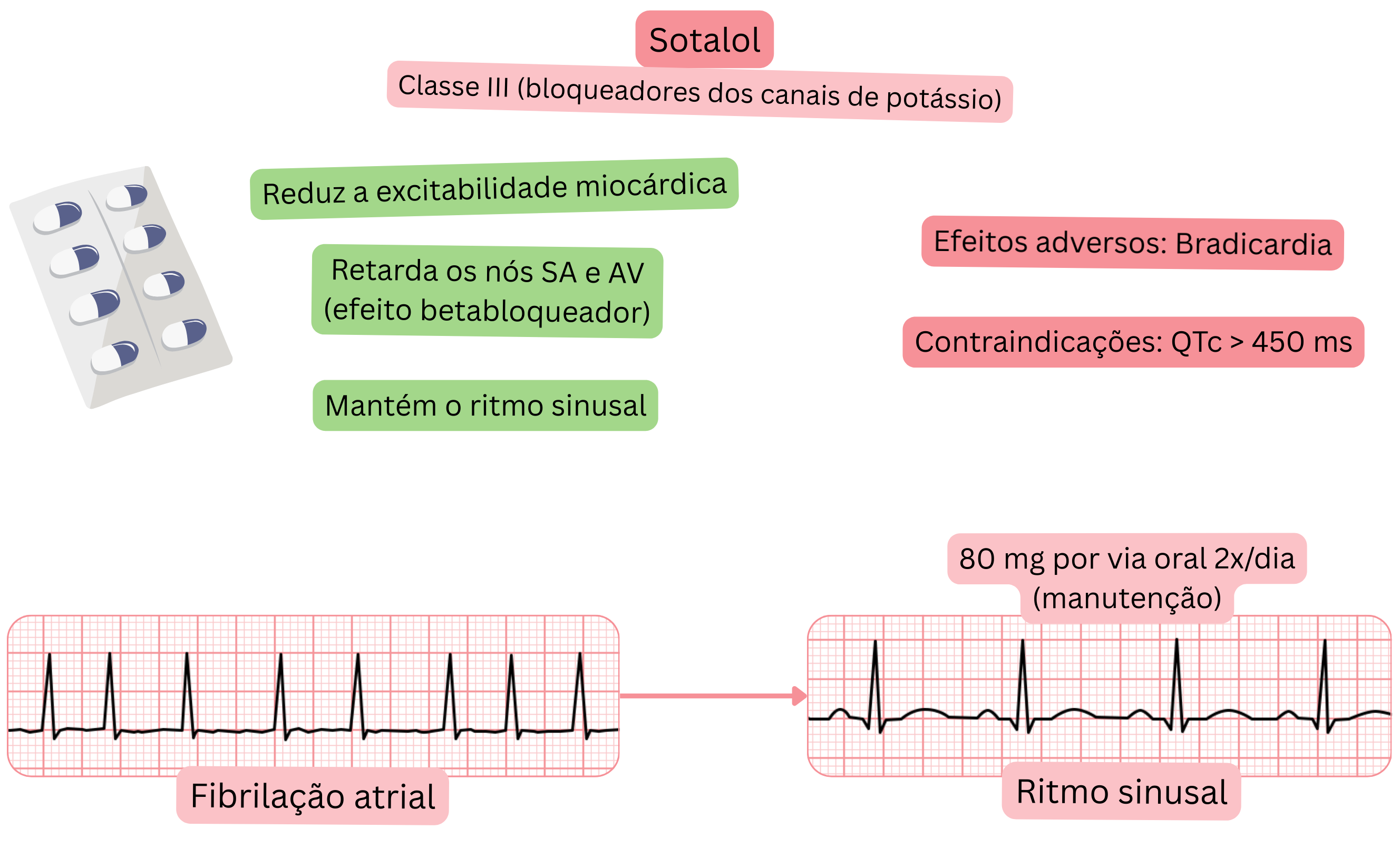 Esquema do efeito do sotalol como antiarrítmico de classe III demonstrando bloqueio dos canais de potássio com lentificação dos nós SA e AV, redução da excitabilidade miocárdica e manutenção do ritmo sinusal na fibrilação atrial.