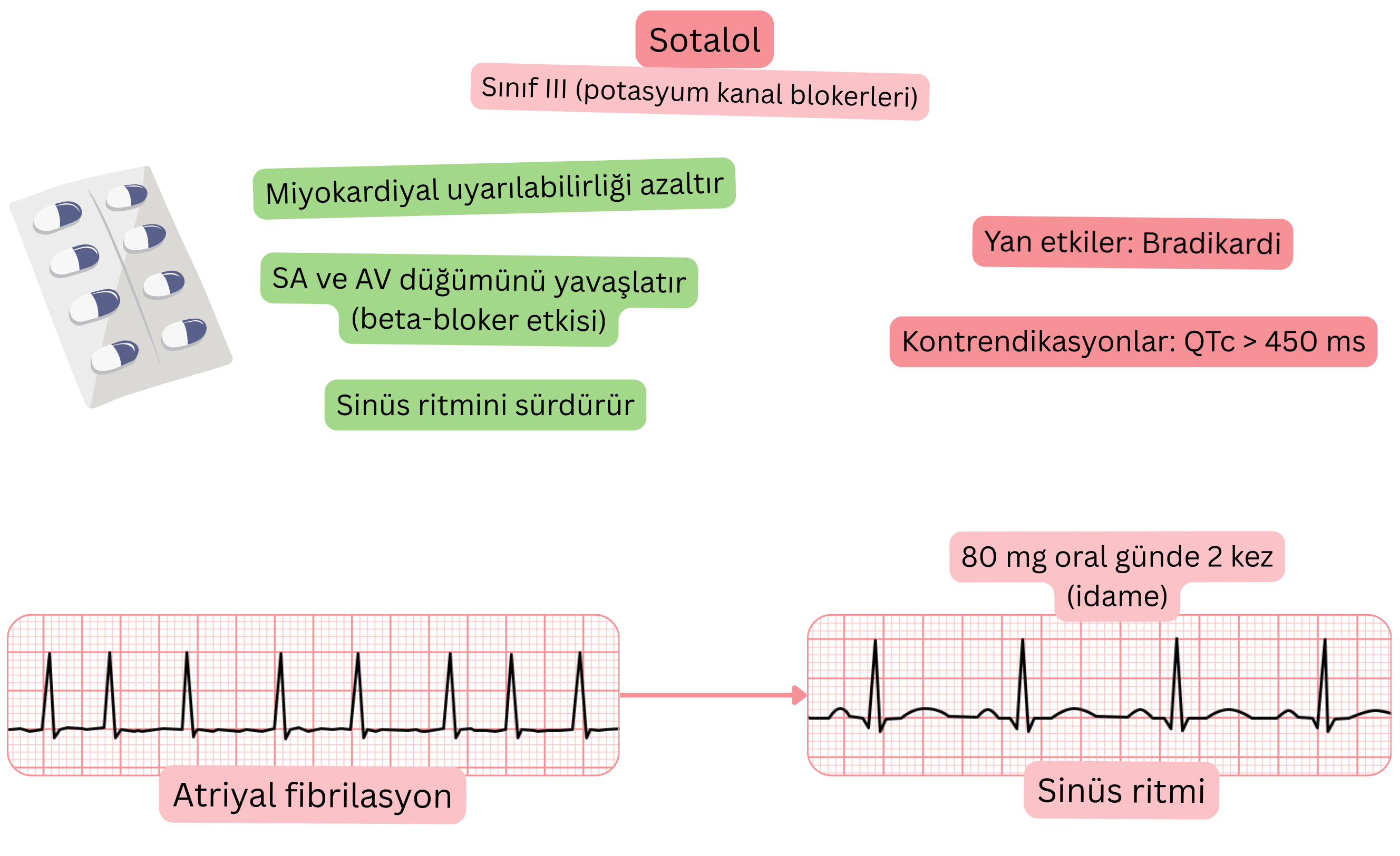 III sınıfı antiaritmik olarak sotalolün etkisini gösteren şema; potasyum kanal blokajı ile SA ve AV düğümün yavaşlamasını, miyokard uyarılabilirliğinin azalmasını ve atriyal fibrilasyonda sinüs ritminin sürdürülmesini göstermektedir.