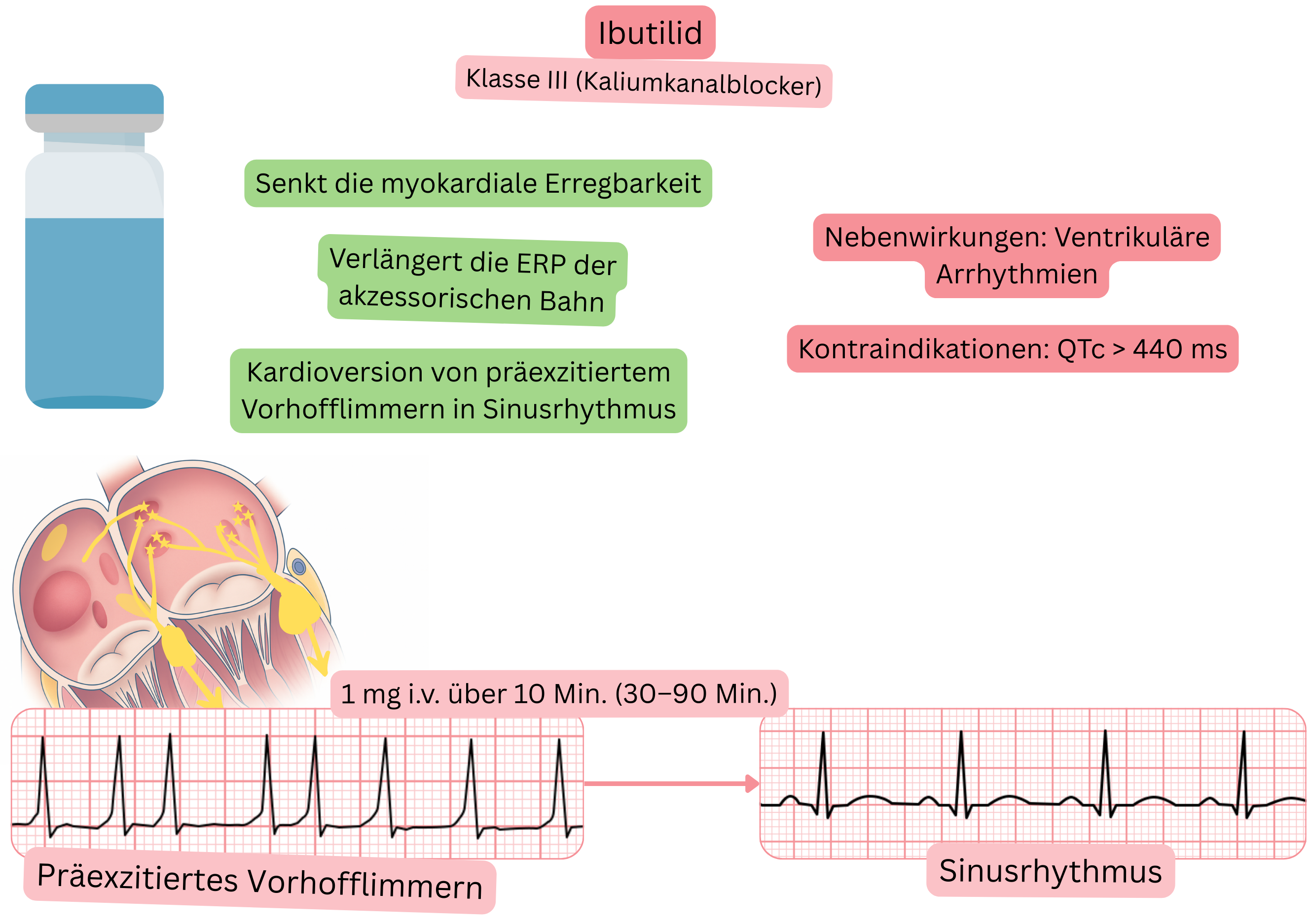 Schema der Wirkung von Ibutilid als Antiarrhythmikum der Klasse III mit Darstellung der Verlängerung der effektiven Refraktärperiode einer akzessorischen Leitungsbahn und der pharmakologischen Kardioversion des präexzitierten Vorhofflimmerns in den Sinusrhythmus.