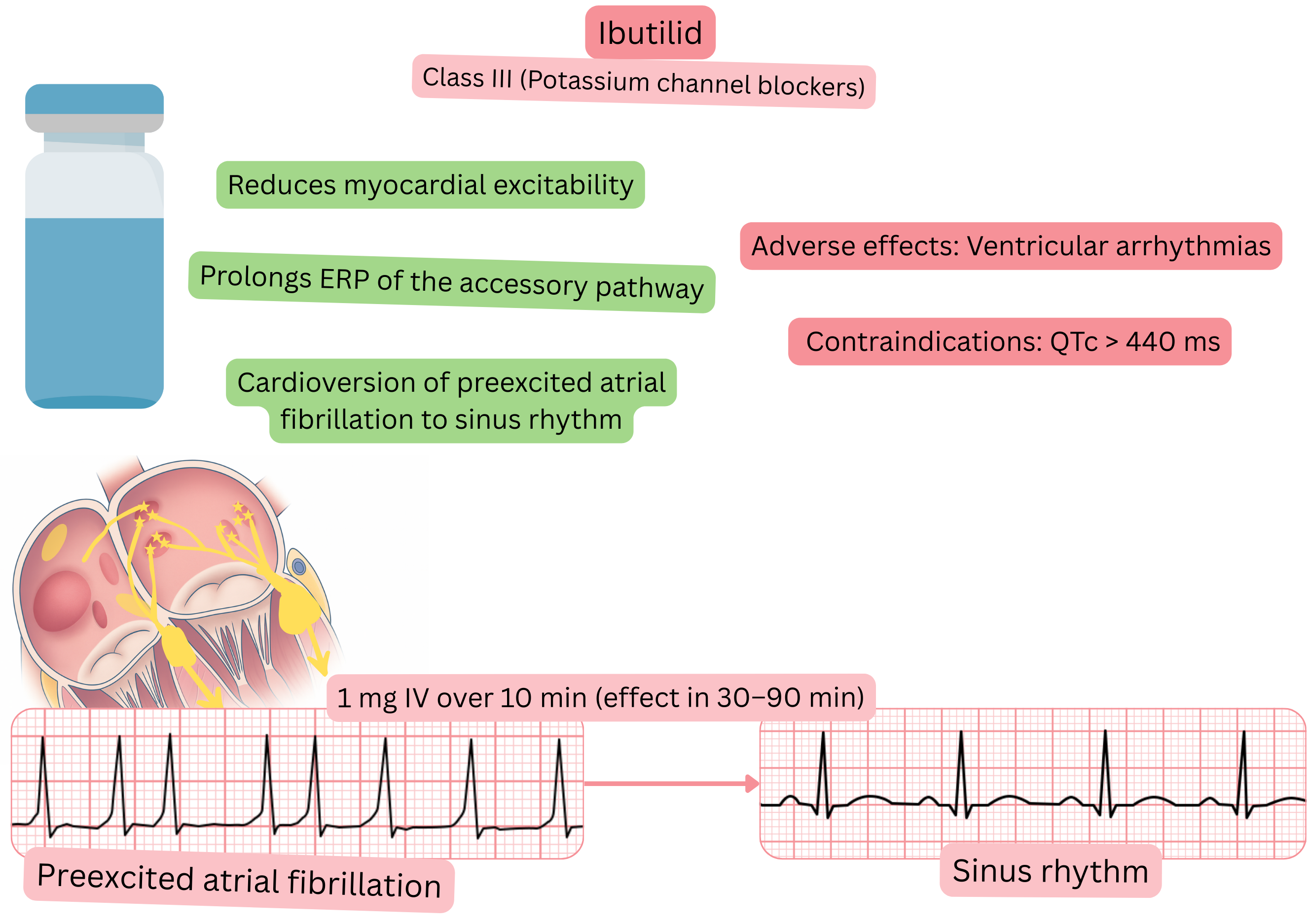 Diagram of the effect of ibutilide as a class III antiarrhythmic illustrating prolongation of the effective refractory period of an accessory pathway and pharmacological cardioversion of preexcited atrial fibrillation to sinus rhythm.