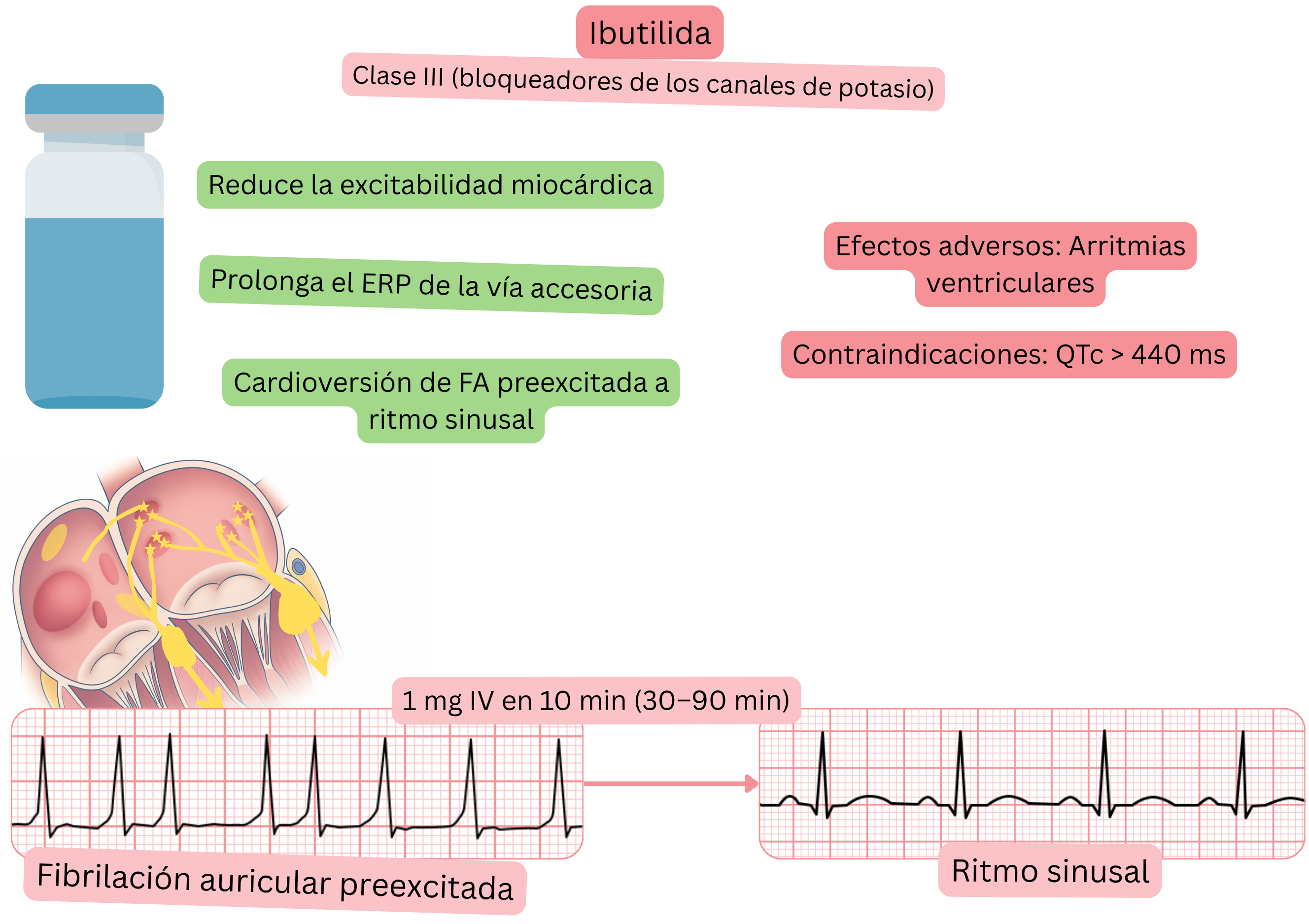 Esquema del efecto del ibutilide como antiarrítmico de clase III que muestra la prolongación del período refractario efectivo de la vía accesoria y la cardioversión farmacológica de la fibrilación auricular preexcitada a ritmo sinusal.