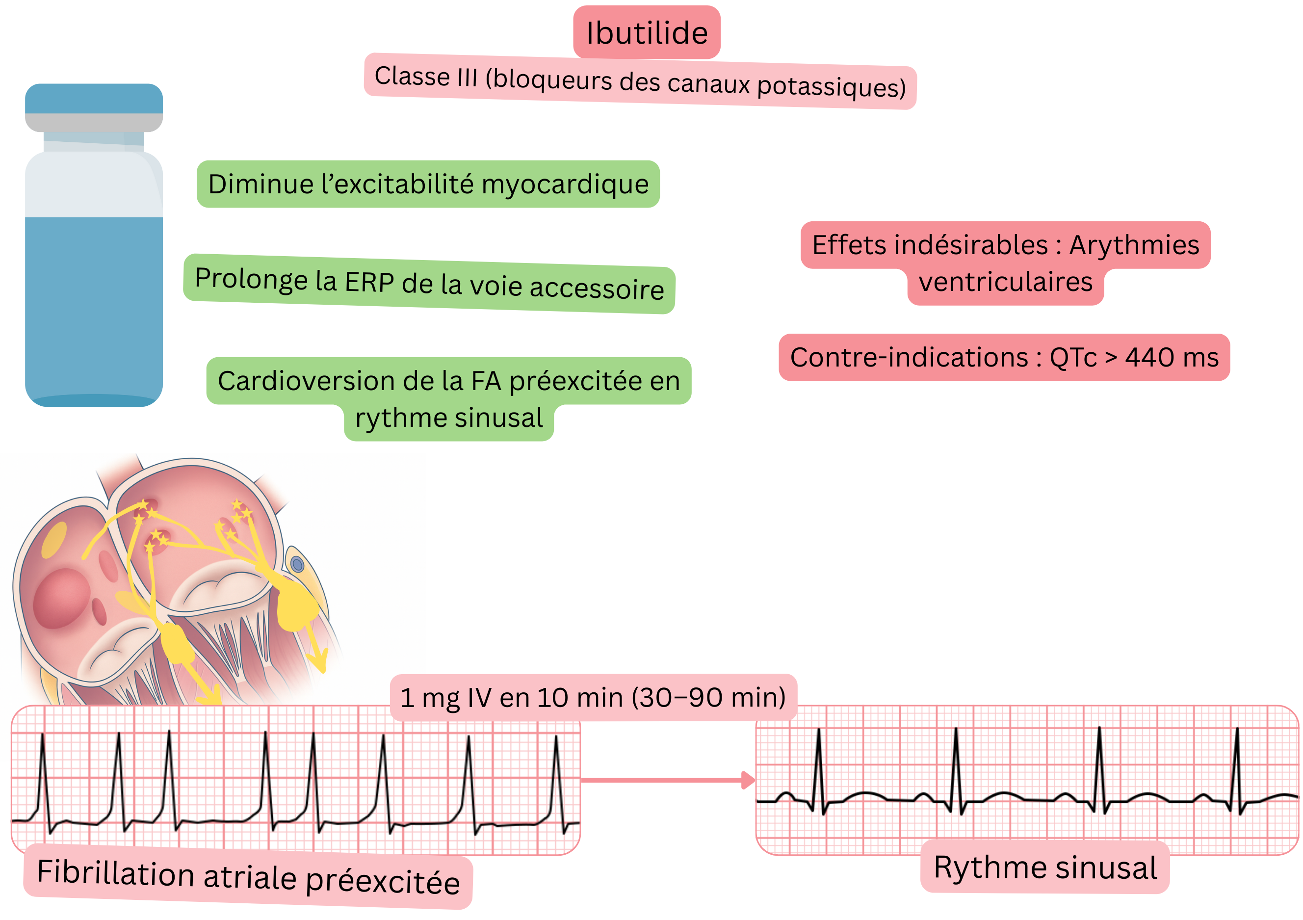 Schéma de l’effet de l’ibutilide comme antiarythmique de classe III illustrant l’allongement de la période réfractaire effective de la voie accessoire et la cardioversion pharmacologique de la fibrillation auriculaire préexcitée en rythme sinusal.