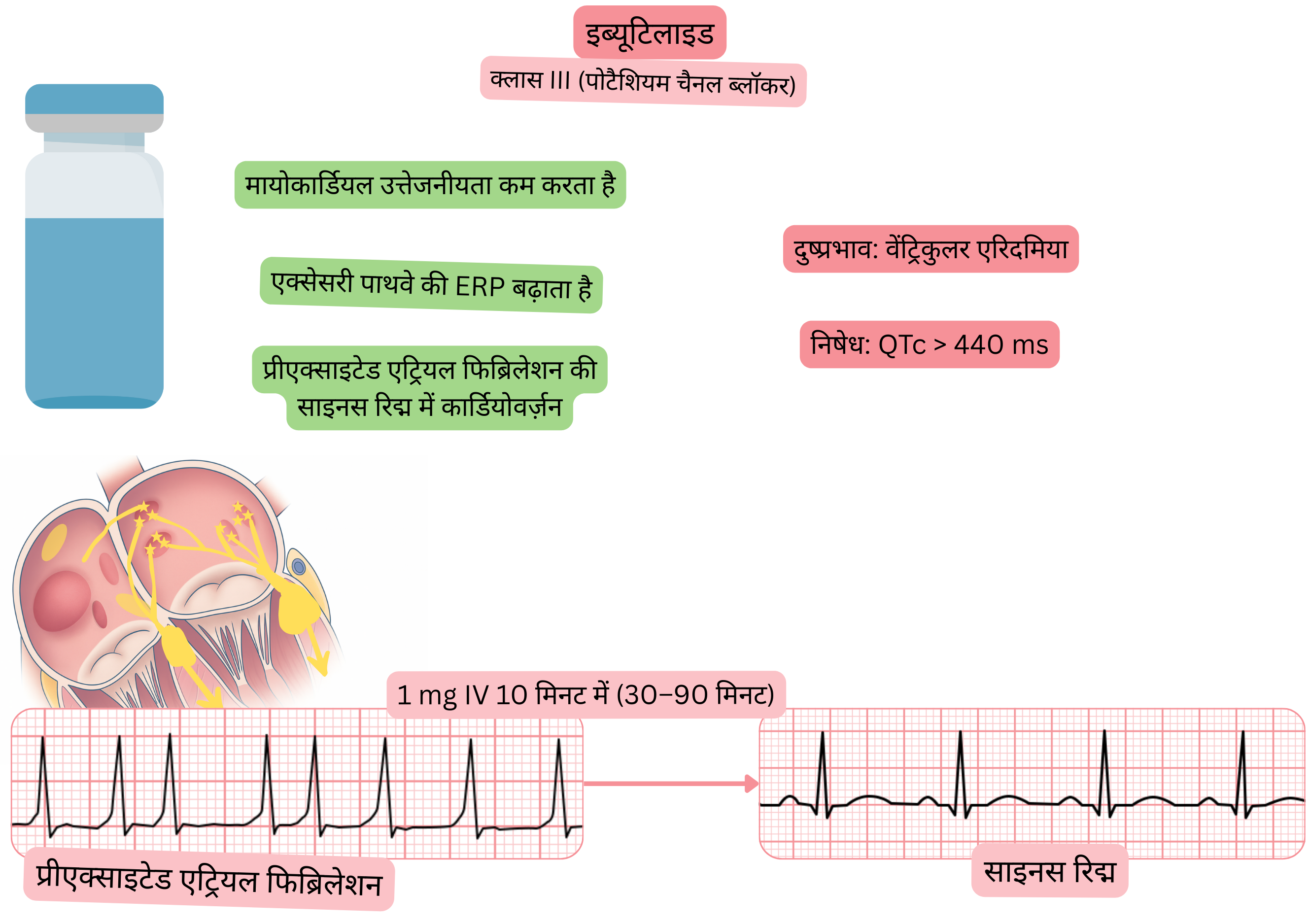 क्लास III एंटीएरिदमिक के रूप में इब्यूटिलाइड के प्रभाव का आरेख, जिसमें एक्सेसरी पाथवे की प्रभावी रिफ्रैक्टरी अवधि के बढ़ने और प्रीएक्साइटेड एट्रियल फिब्रिलेशन की औषधीय कार्डियोवर्ज़न द्वारा साइनस रिद्म की बहाली दर्शाई गई है।