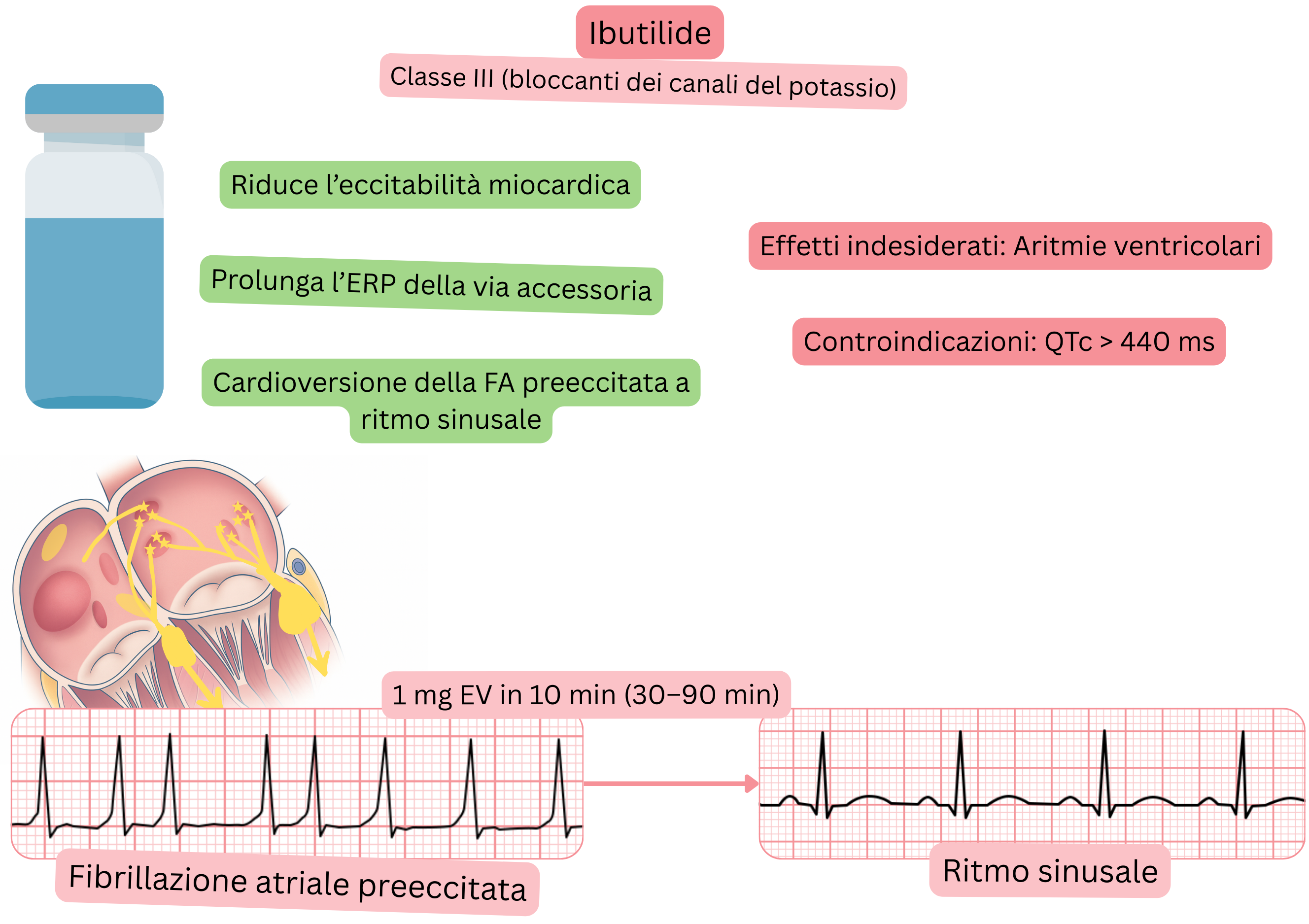 Schema dell’effetto dell’ibutilide come antiaritmico di classe III che illustra il prolungamento del periodo refrattario efficace della via accessoria e la cardioversione farmacologica della fibrillazione atriale preeccitata al ritmo sinusale.