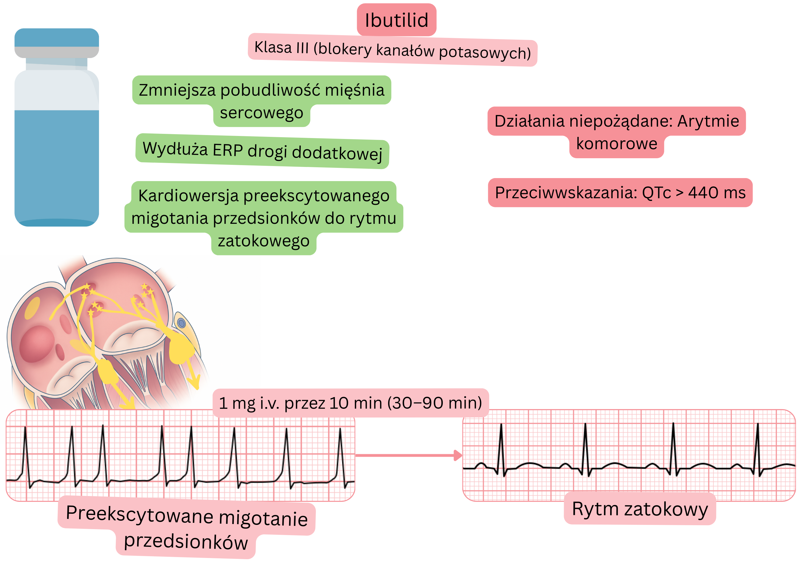 Schemat działania ibutilidu jako leku antyarytmicznego klasy III, przedstawiający wydłużenie efektywnego okresu refrakcji drogi dodatkowej oraz farmakologiczną kardiowersję preekscytowanego migotania przedsionków do rytmu zatokowego.