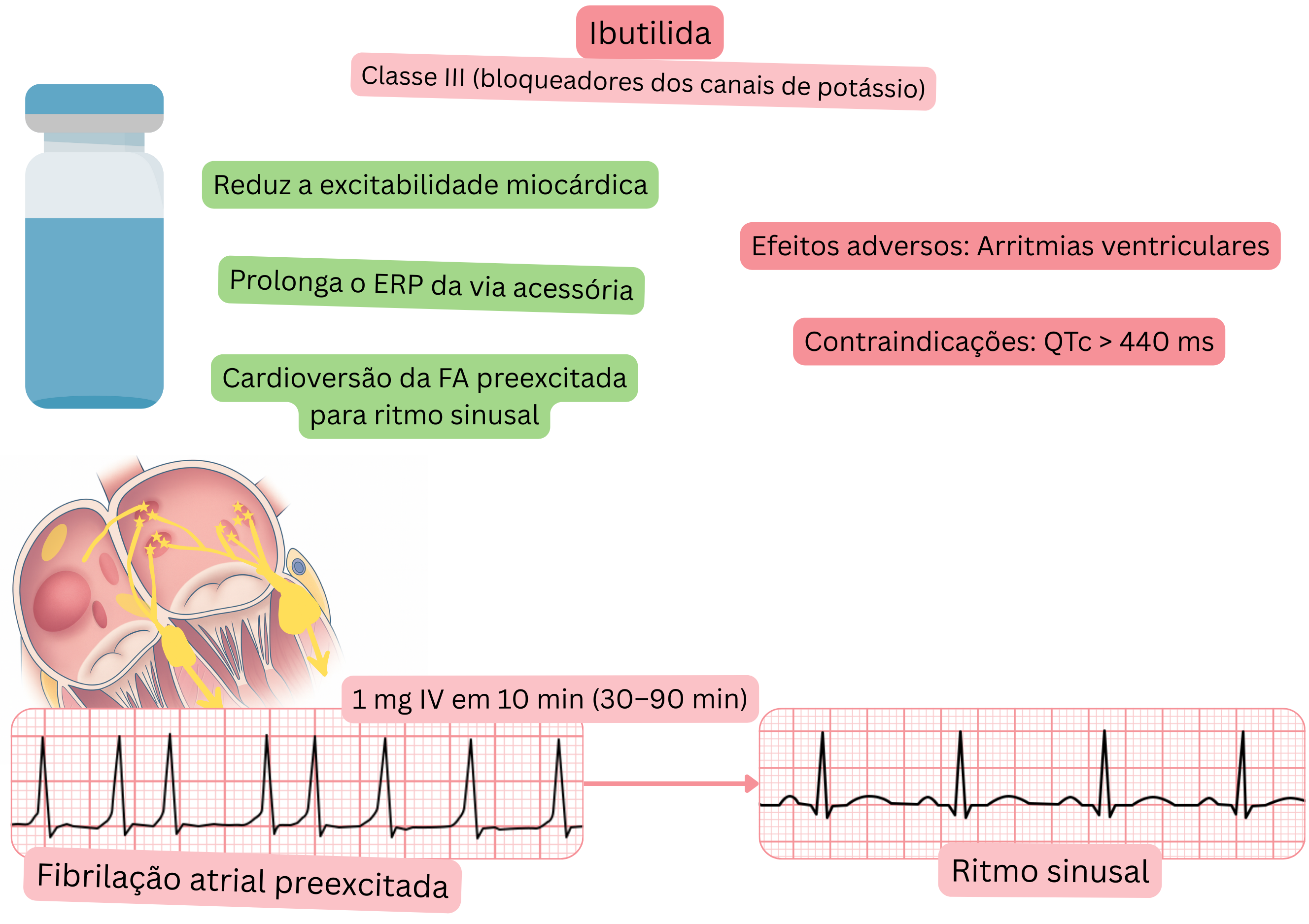 Esquema do efeito do ibutilide como antiarrítmico de classe III demonstrando o prolongamento do período refratário efetivo da via acessória e a cardioversão farmacológica da fibrilação atrial preexcitada para ritmo sinusal.
