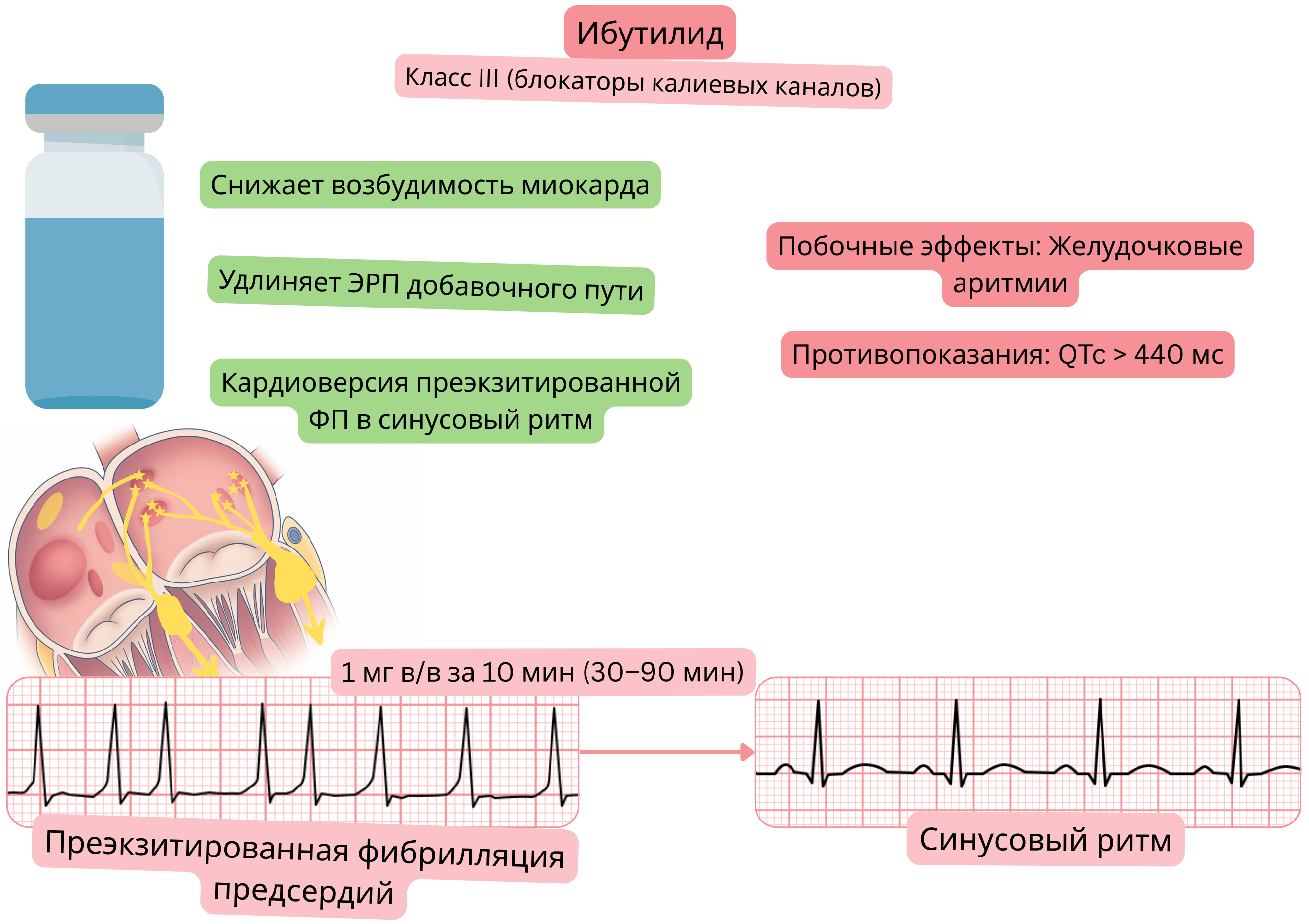 Схема действия ибутилида как антиаритмического препарата класса III, демонстрирующая удлинение эффективного рефрактерного периода дополнительного пути проведения и фармакологическую кардиоверсию преэксцитированной фибрилляции предсердий в синусовый ритм.