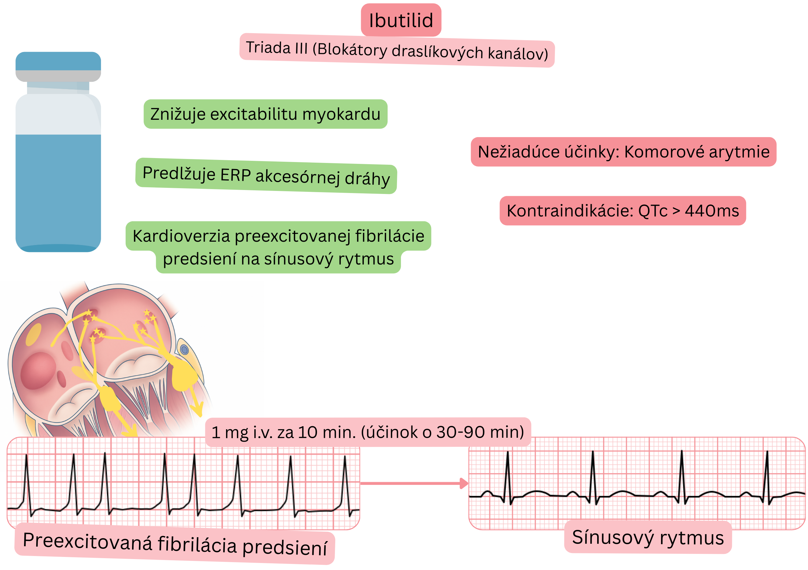 Schéma účinku ibutilidu ako antiarytmika triedy III znázorňujúca predĺženie efektívnej refraktérnej periódy akcesórnej dráhy a farmakologickú kardioverziu preexcitovanej fibrilácie predsiení na sínusový rytmus.