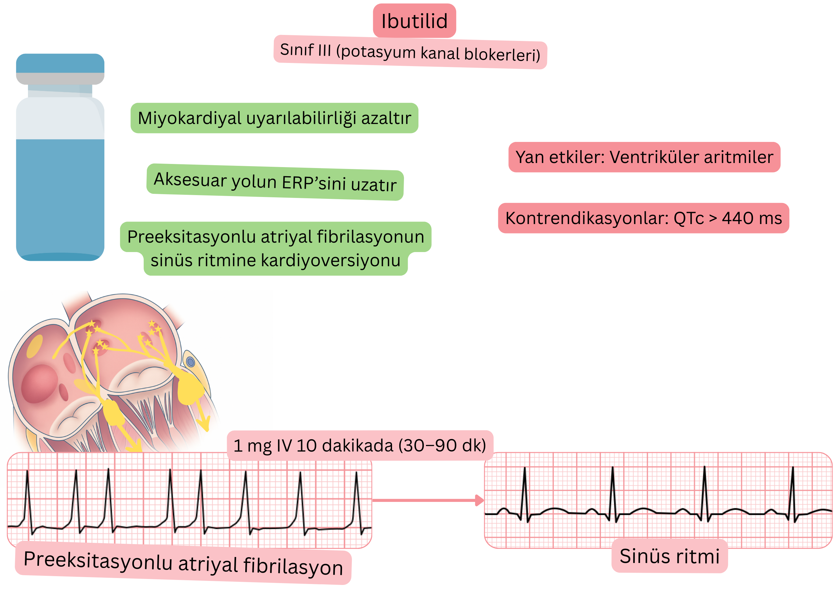 III sınıfı antiaritmik olarak ibutilidin etkisini gösteren şema; aksesuar yolun efektif refrakter periyodunun uzamasını ve preeksitasyonlu atriyal fibrilasyonun farmakolojik olarak sinüs ritmine kardiyoversiyonunu göstermektedir.