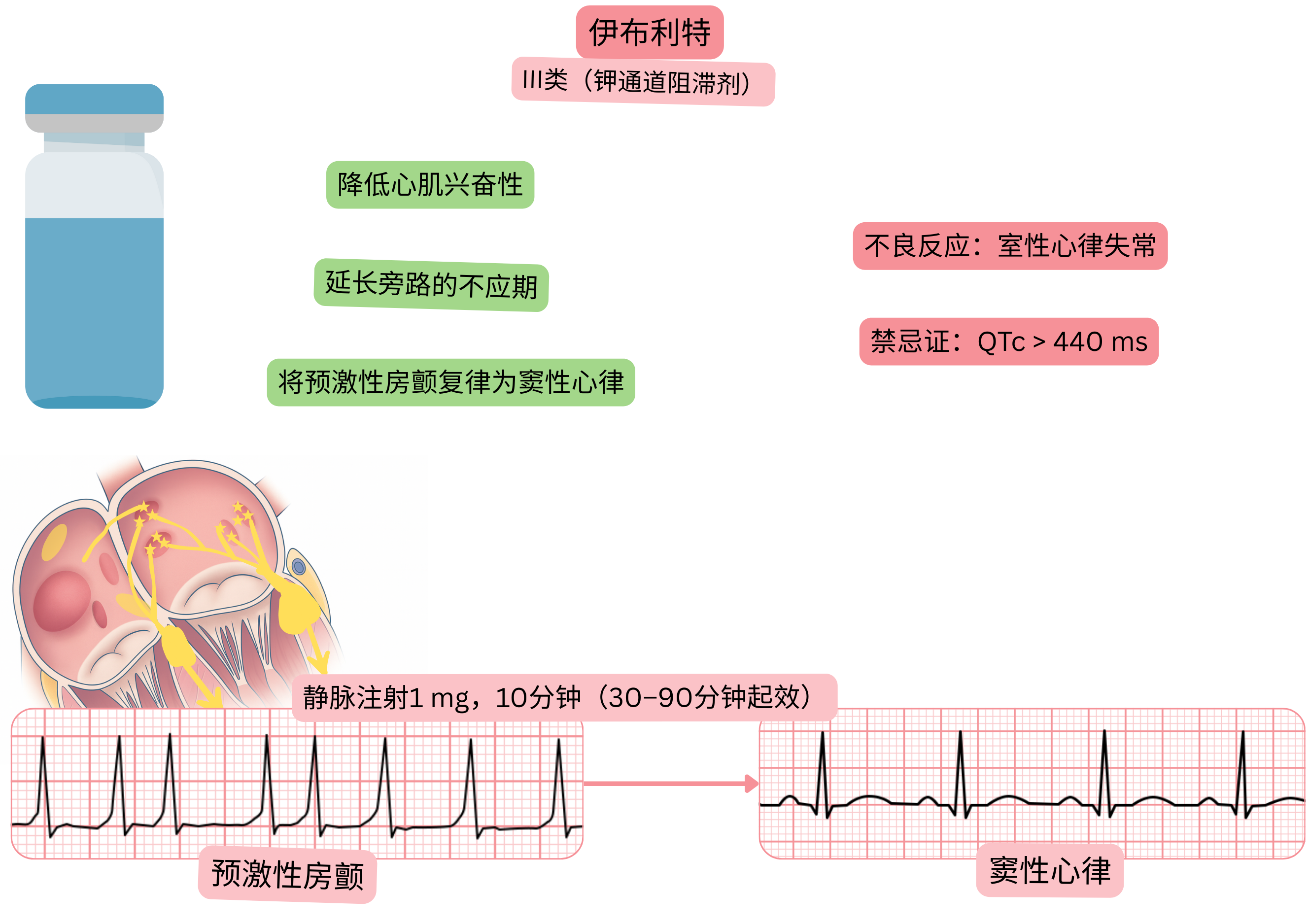 伊布利特作为III类抗心律失常药物的作用示意图，显示旁道有效不应期延长以及预激性心房颤动的药物性复律至窦性心律。