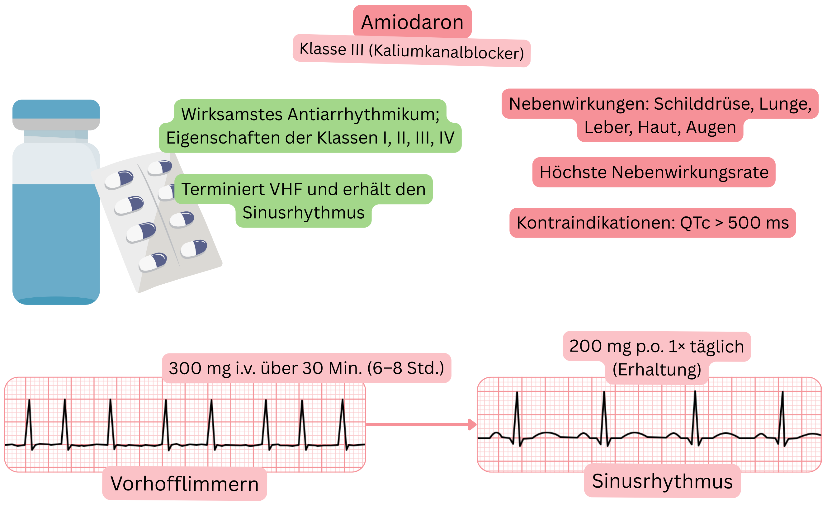 Schema der Wirkung von Amiodaron als Antiarrhythmikum der Klasse III mit multikanalem Wirkmechanismus, das die pharmakologische Kardioversion von Vorhofflimmern und die Aufrechterhaltung des Sinusrhythmus darstellt.