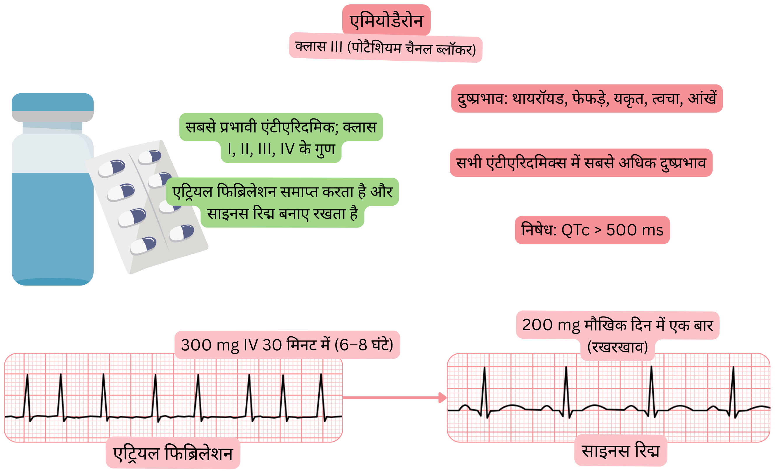 मल्टीचैनल प्रभाव वाले क्लास III एंटीएरिदमिक के रूप में अमियोडैरोन के प्रभाव का आरेख, जिसमें एट्रियल फिब्रिलेशन की औषधीय कार्डियोवर्ज़न और साइनस रिद्म के रखरखाव को दर्शाया गया है।