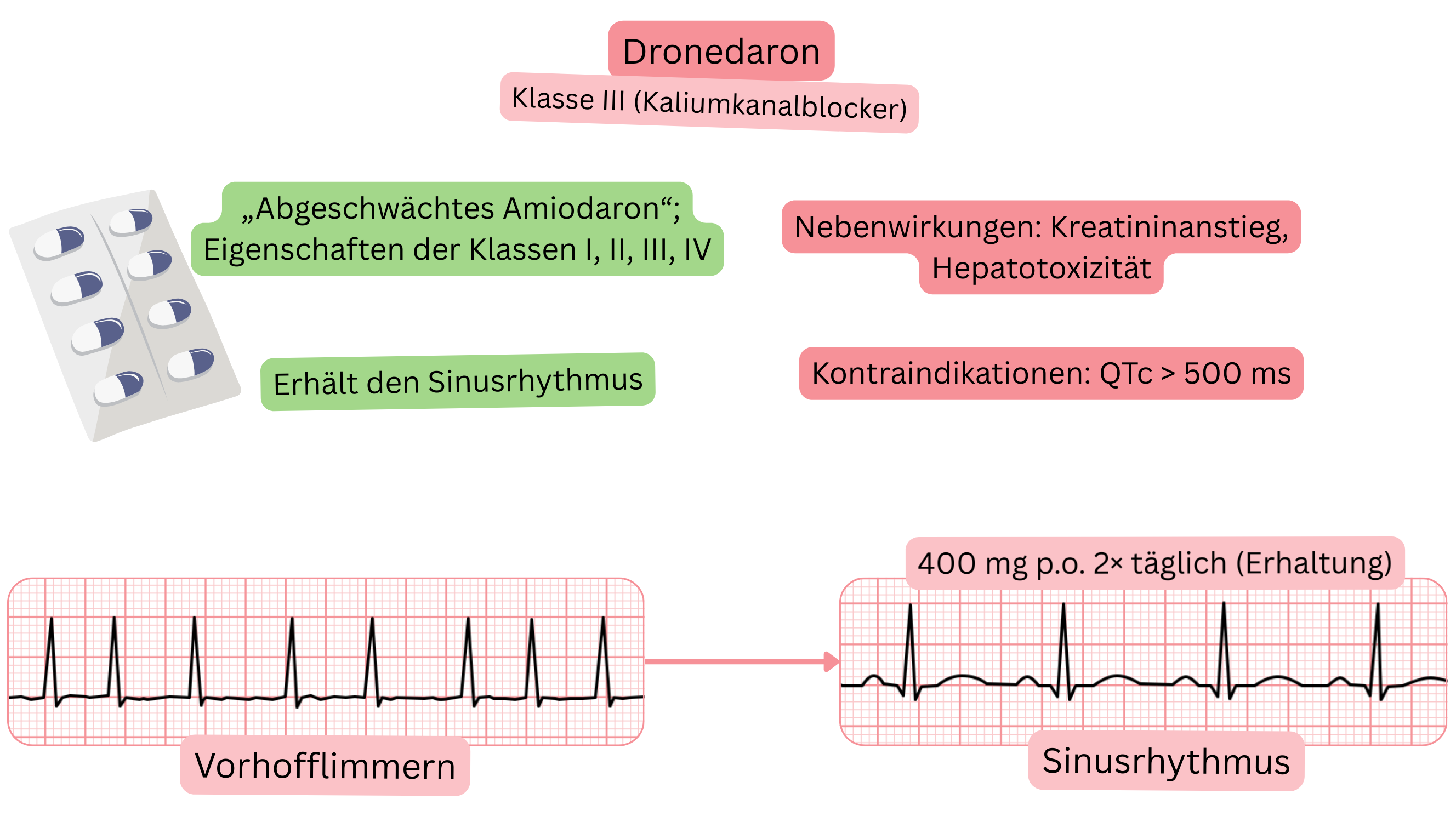 Schema der Wirkung von Dronedaron als Antiarrhythmikum der Klasse III mit Darstellung der multikanalen Wirkung, der Aufrechterhaltung des Sinusrhythmus und der pharmakologischen Behandlung des Vorhofflimmerns.