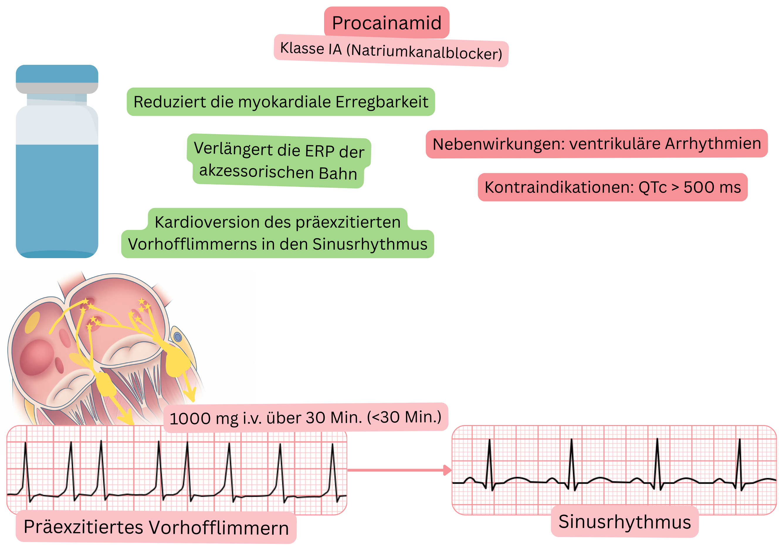 Schema der Wirkung von Procainamid als Antiarrhythmikum der Klasse IA mit Darstellung der Reduktion der myokardialen Erregbarkeit, Verlängerung der effektiven Refraktärperiode einer akzessorischen Leitungsbahn und der pharmakologischen Kardioversion des präexzitierten Vorhofflimmerns in den Sinusrhythmus.