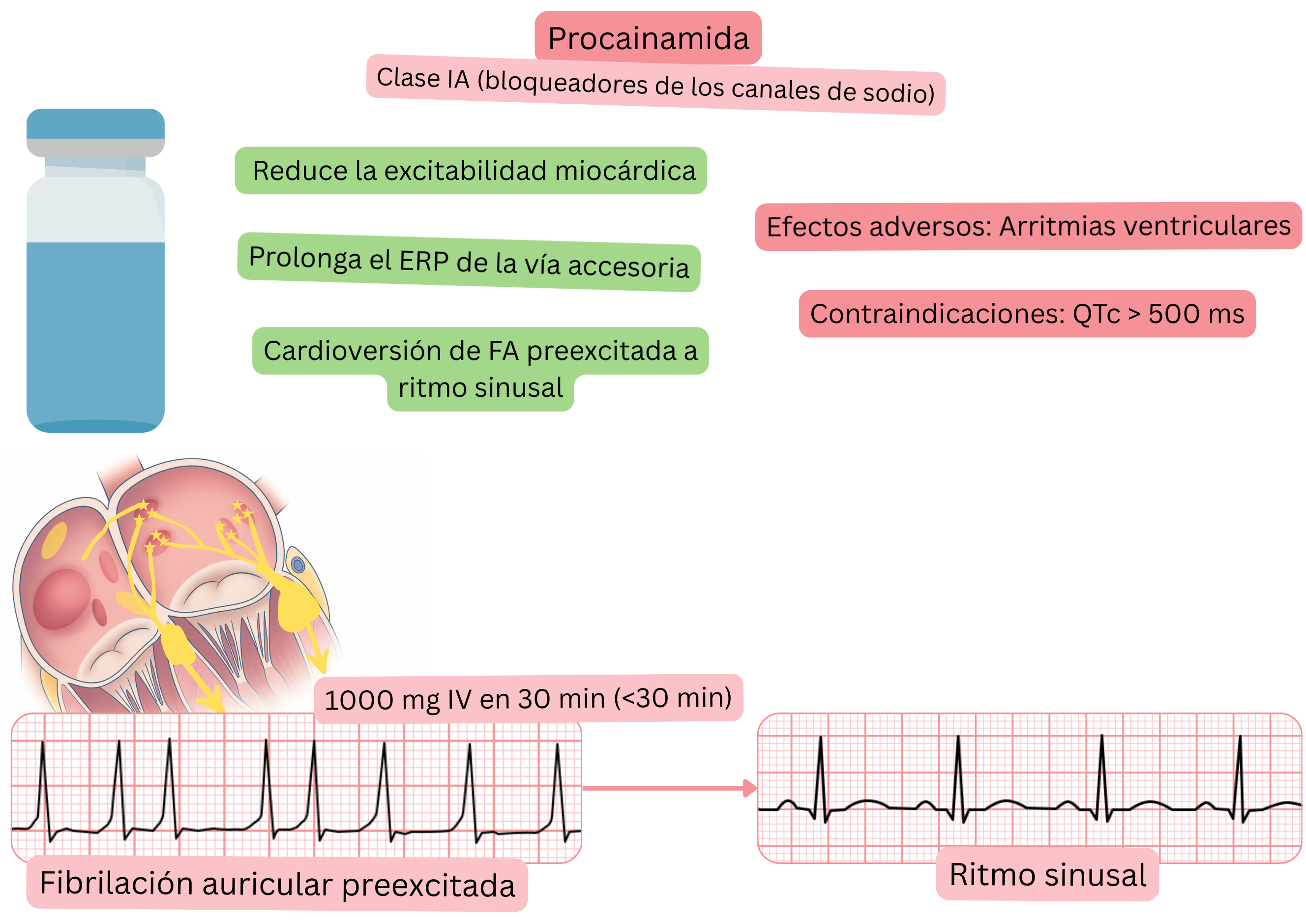 Esquema del efecto de la procainamida como antiarrítmico de clase IA que muestra la reducción de la excitabilidad miocárdica, la prolongación del período refractario efectivo de la vía accesoria y la cardioversión farmacológica de la fibrilación auricular preexcitada a ritmo sinusal.