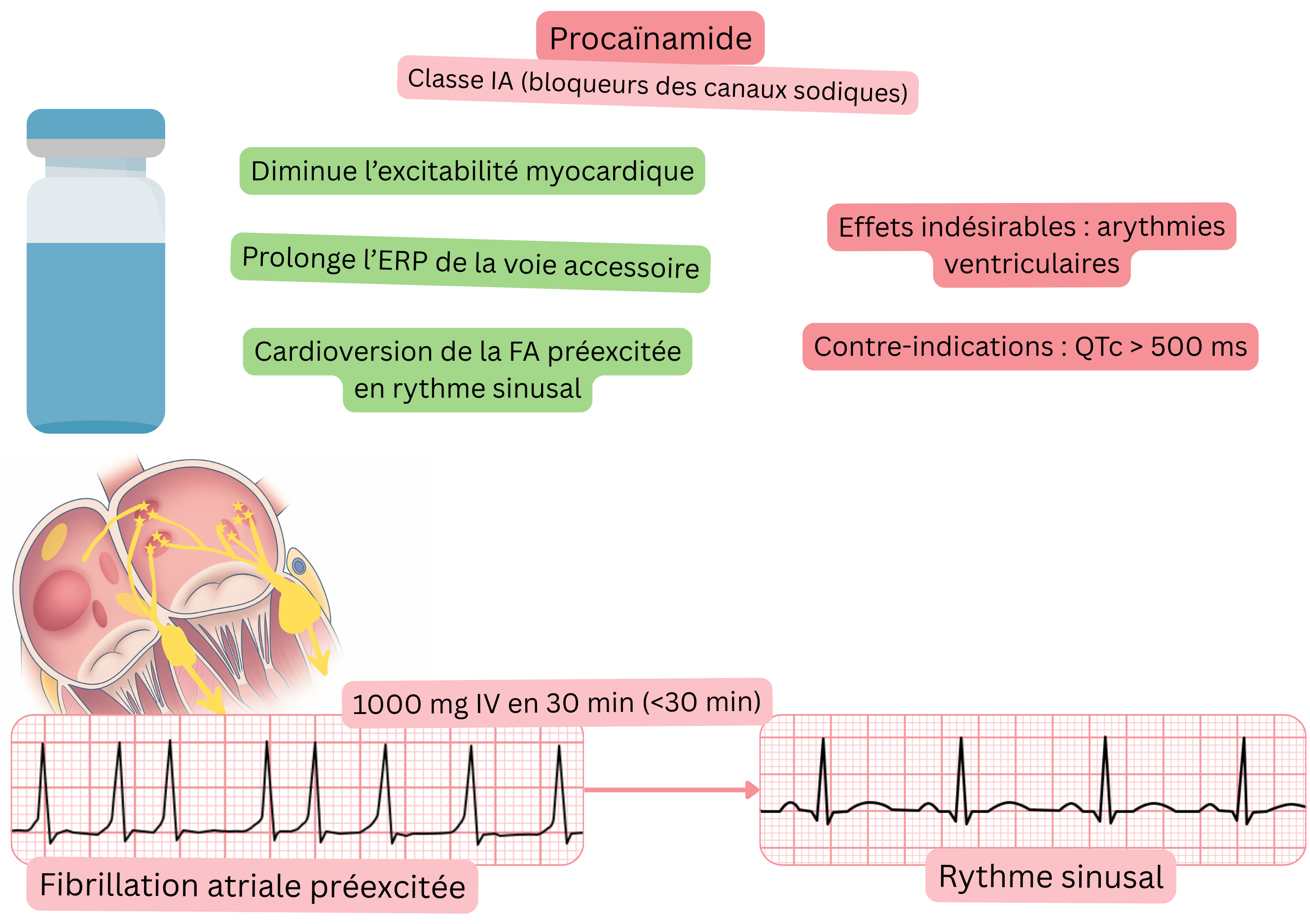 Schéma de l’effet de la procaïnamide comme antiarythmique de classe IA illustrant la diminution de l’excitabilité myocardique, l’allongement de la période réfractaire effective de la voie accessoire et la cardioversion pharmacologique de la fibrillation auriculaire préexcitée en rythme sinusal.