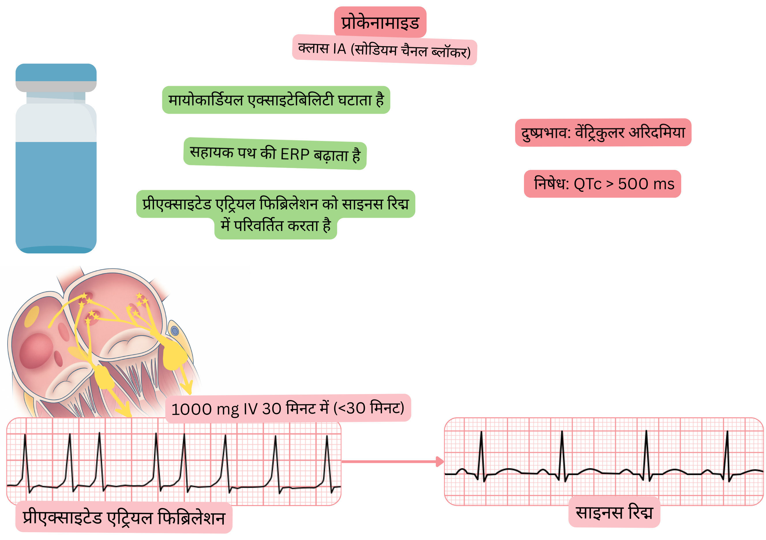 क्लास IA एंटीएरिदमिक के रूप में प्रोकेनामाइड के प्रभाव का आरेख, जिसमें मायोकार्डियल उत्तेजनीयता में कमी, एक्सेसरी पाथवे की प्रभावी रिफ्रैक्टरी अवधि का बढ़ना तथा प्रीएक्साइटेड एट्रियल फिब्रिलेशन की औषधीय कार्डियोवर्ज़न द्वारा साइनस रिद्म की बहाली दर्शाई गई है।