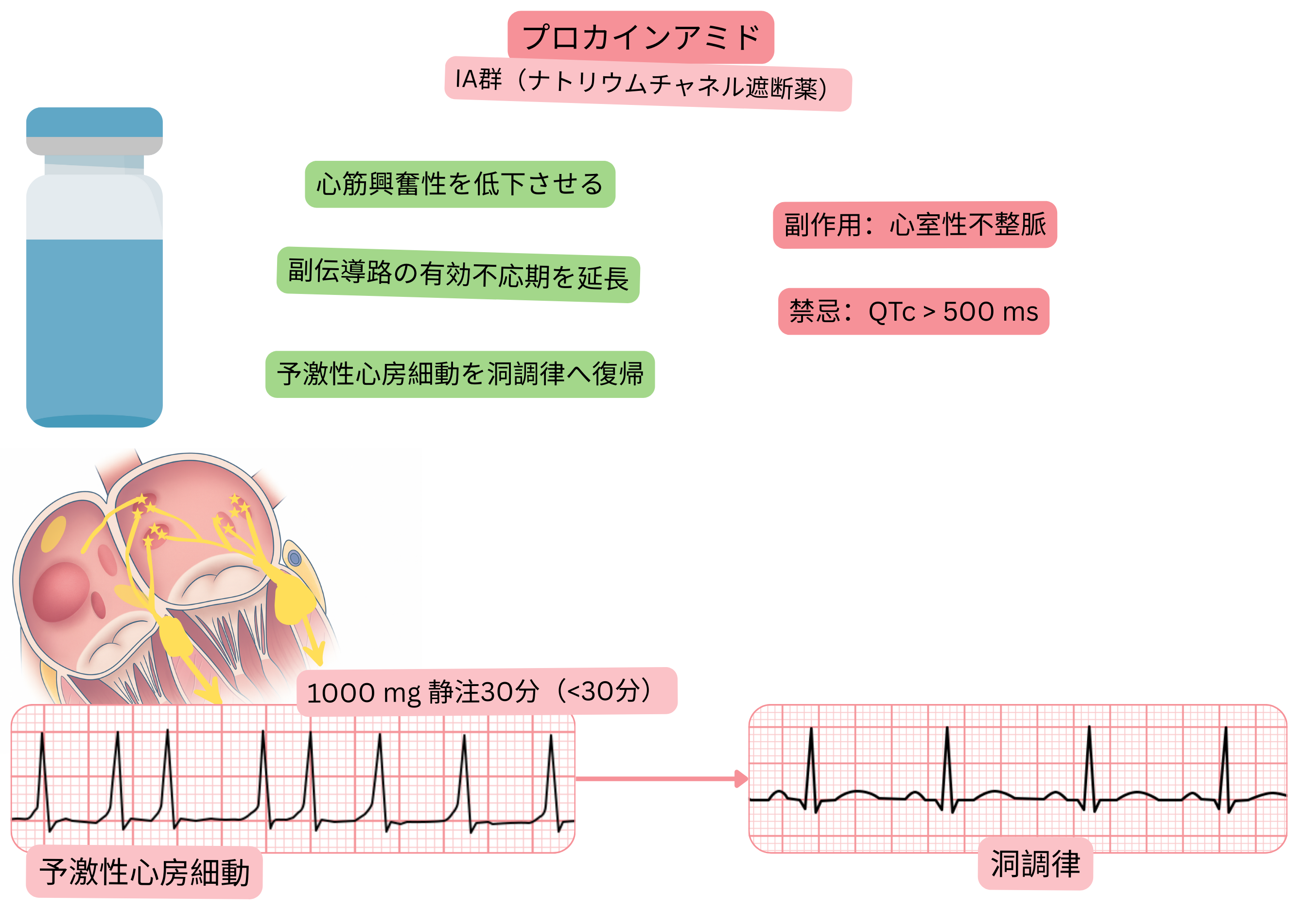IA群抗不整脈薬としてのプロカインアミドの作用を示す模式図で、心筋興奮性の低下、副伝導路の有効不応期延長、および前興奮性心房細動の薬物的洞調律化を示す。