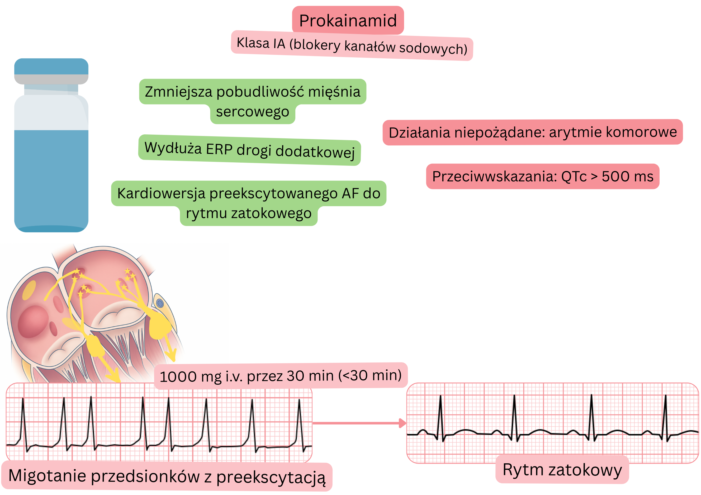 Schemat działania prokainamidu jako leku antyarytmicznego klasy IA, przedstawiający zmniejszenie pobudliwości mięśnia sercowego, wydłużenie efektywnego okresu refrakcji drogi dodatkowej oraz farmakologiczną kardiowersję preekscytowanego migotania przedsionków do rytmu zatokowego.