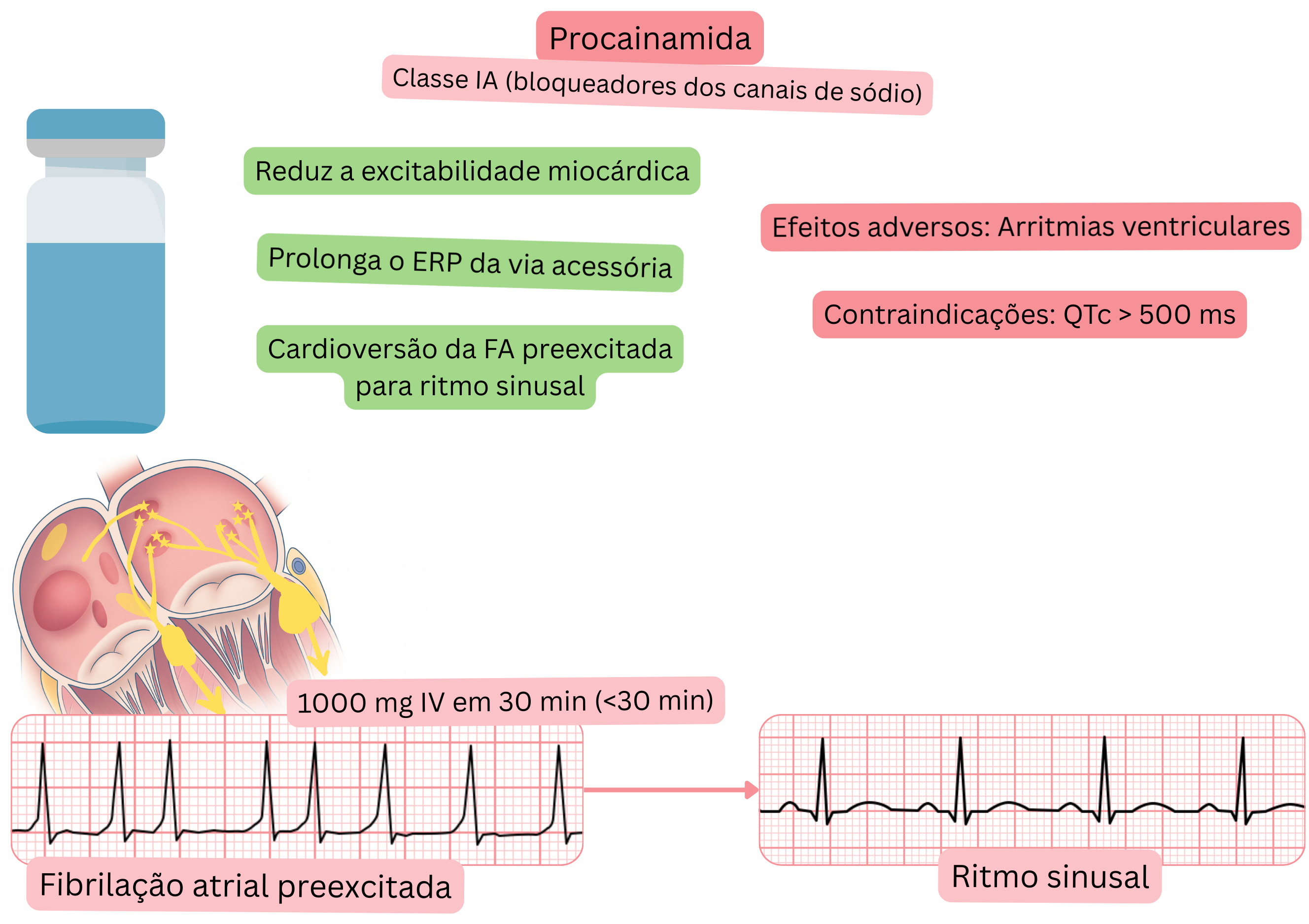 Esquema do efeito da procainamida como antiarrítmico de classe IA demonstrando redução da excitabilidade miocárdica, prolongamento do período refratário efetivo da via acessória e cardioversão farmacológica da fibrilação atrial preexcitada para ritmo sinusal.