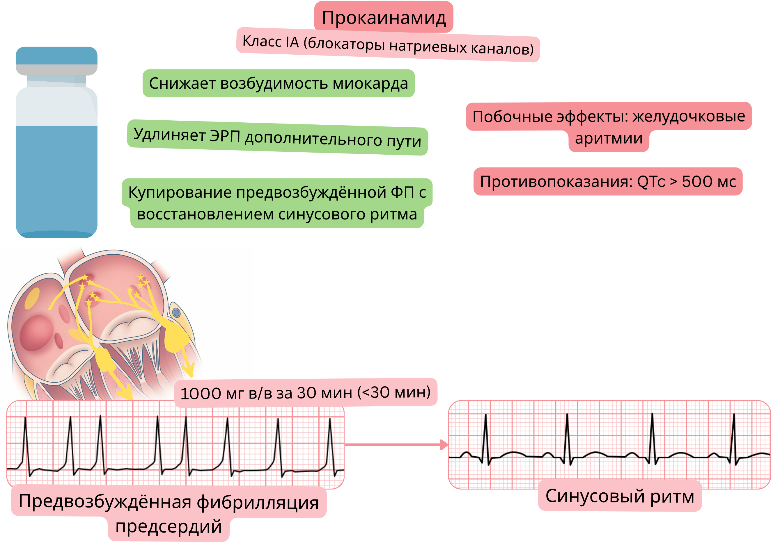 Схема действия прокаинамида как антиаритмического препарата класса IA, демонстрирующая снижение возбудимости миокарда, удлинение эффективного рефрактерного периода дополнительного пути проведения и фармакологическую кардиоверсию преэксцитированной фибрилляции предсердий в синусовый ритм.