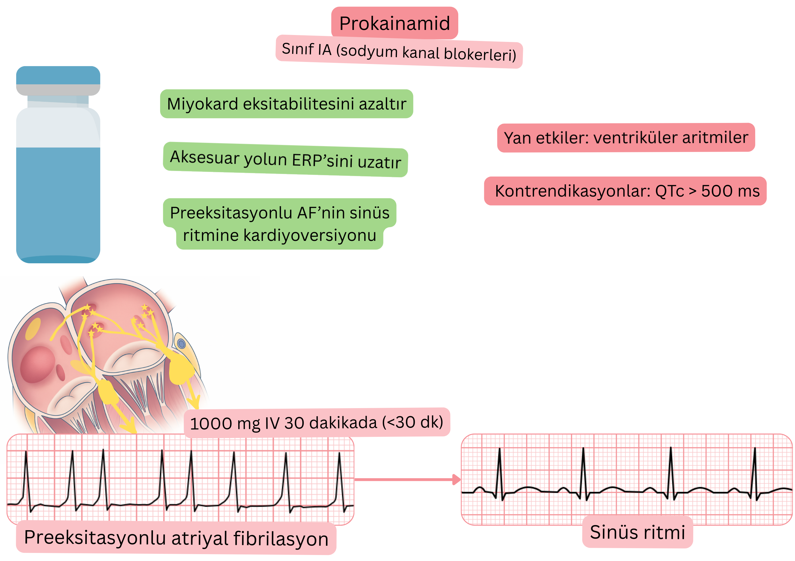 IA sınıfı antiaritmik olarak prokainamidin etkisini gösteren şema; miyokard uyarılabilirliğinin azalmasını, aksesuar yolun efektif refrakter periyodunun uzamasını ve preeksitasyonlu atriyal fibrilasyonun farmakolojik olarak sinüs ritmine kardiyoversiyonunu göstermektedir.
