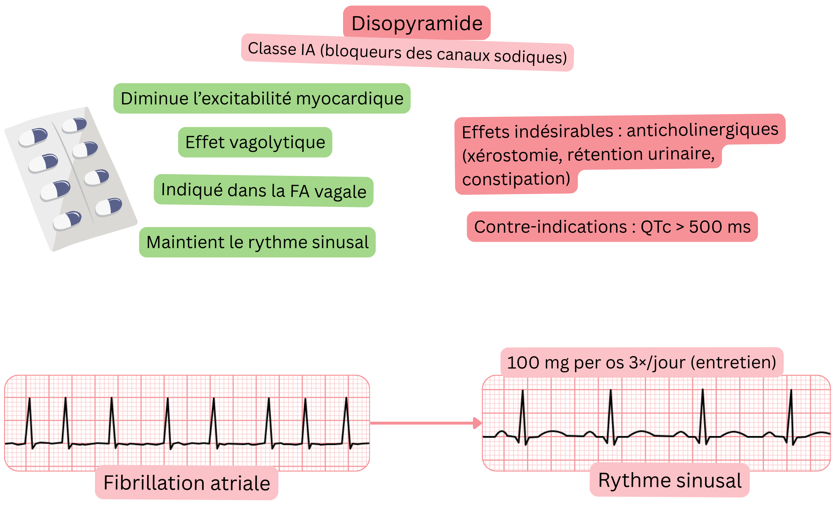 Schéma de l’effet de la disopyramide comme antiarythmique de classe IA illustrant un effet vagolytique, une diminution de l’excitabilité myocardique et le maintien du rythme sinusal dans la fibrillation auriculaire vagale.