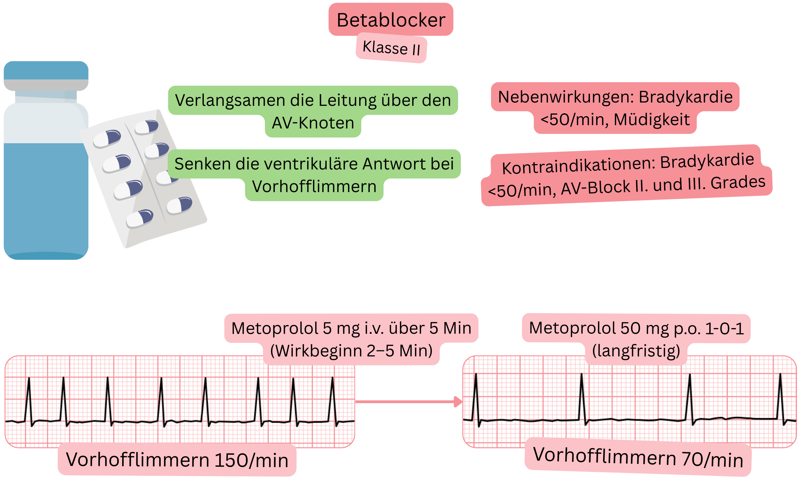 Schema der Wirkung von Betablockern als Antiarrhythmika der Klasse II mit Darstellung der Verlangsamung der Überleitung über den atrioventrikulären Knoten und der Reduktion der ventrikulären Antwort bei Vorhofflimmern.