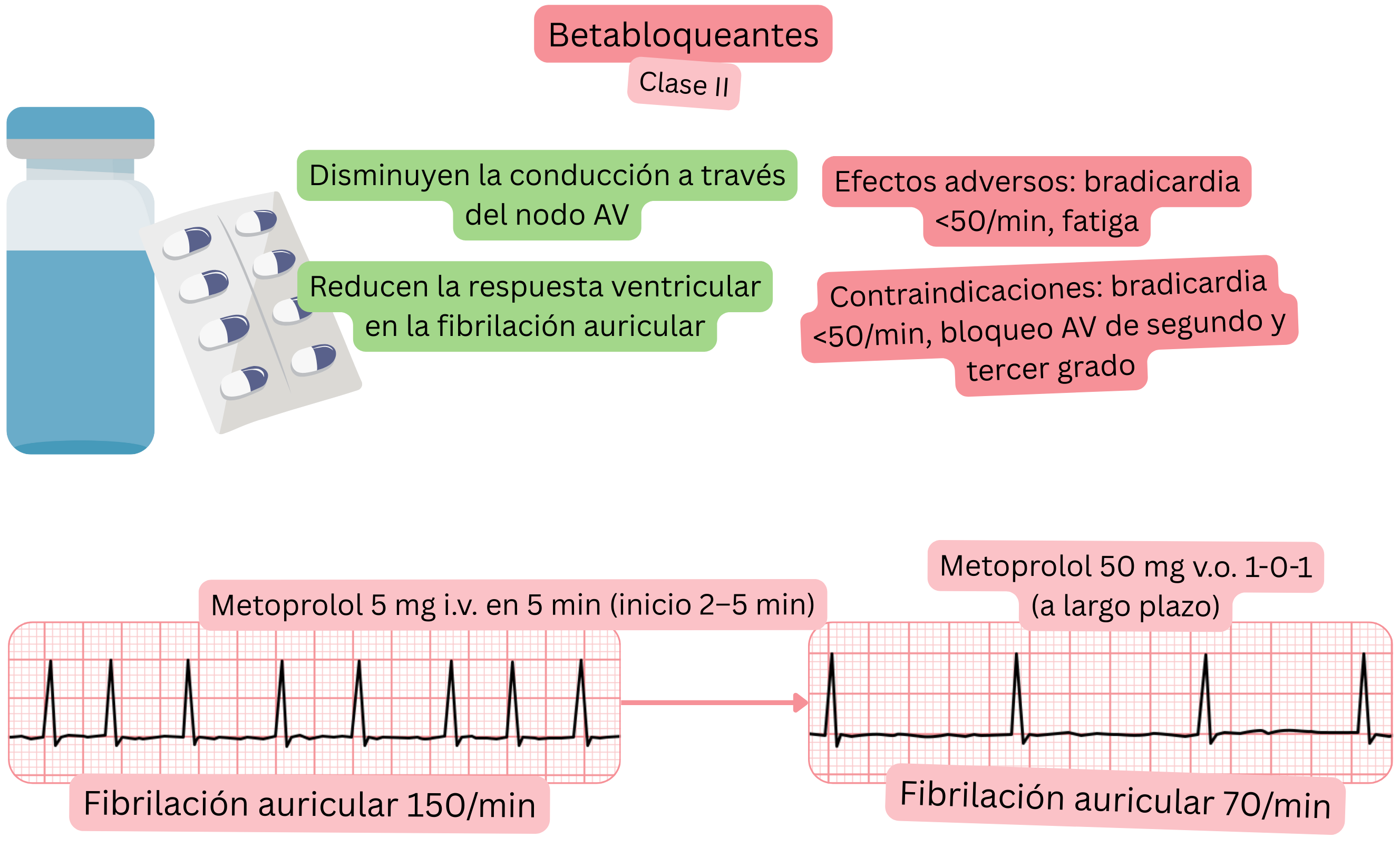 Esquema del efecto de los betabloqueantes como antiarrítmicos de clase II que muestra el enlentecimiento de la conducción a través del nodo auriculoventricular y la reducción de la respuesta ventricular en la fibrilación auricular.