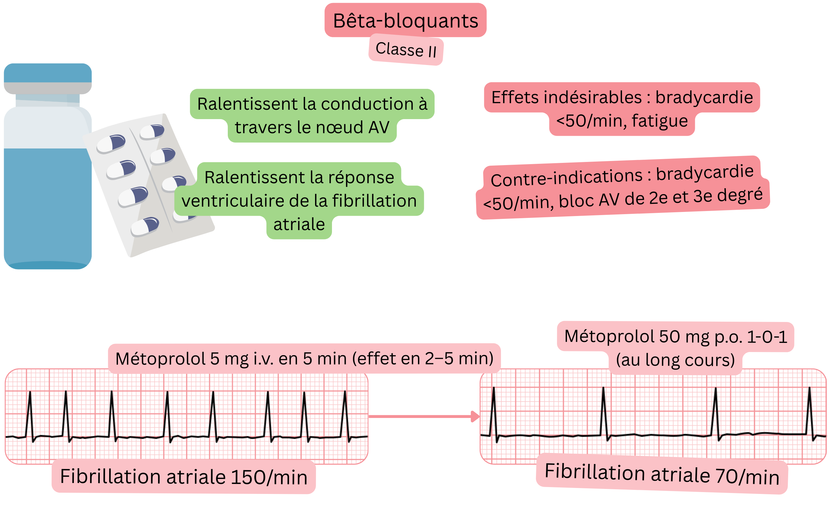 Schéma de l’effet des bêtabloquants comme antiarythmiques de classe II illustrant le ralentissement de la conduction à travers le nœud auriculoventriculaire et la réduction de la réponse ventriculaire lors de la fibrillation auriculaire.