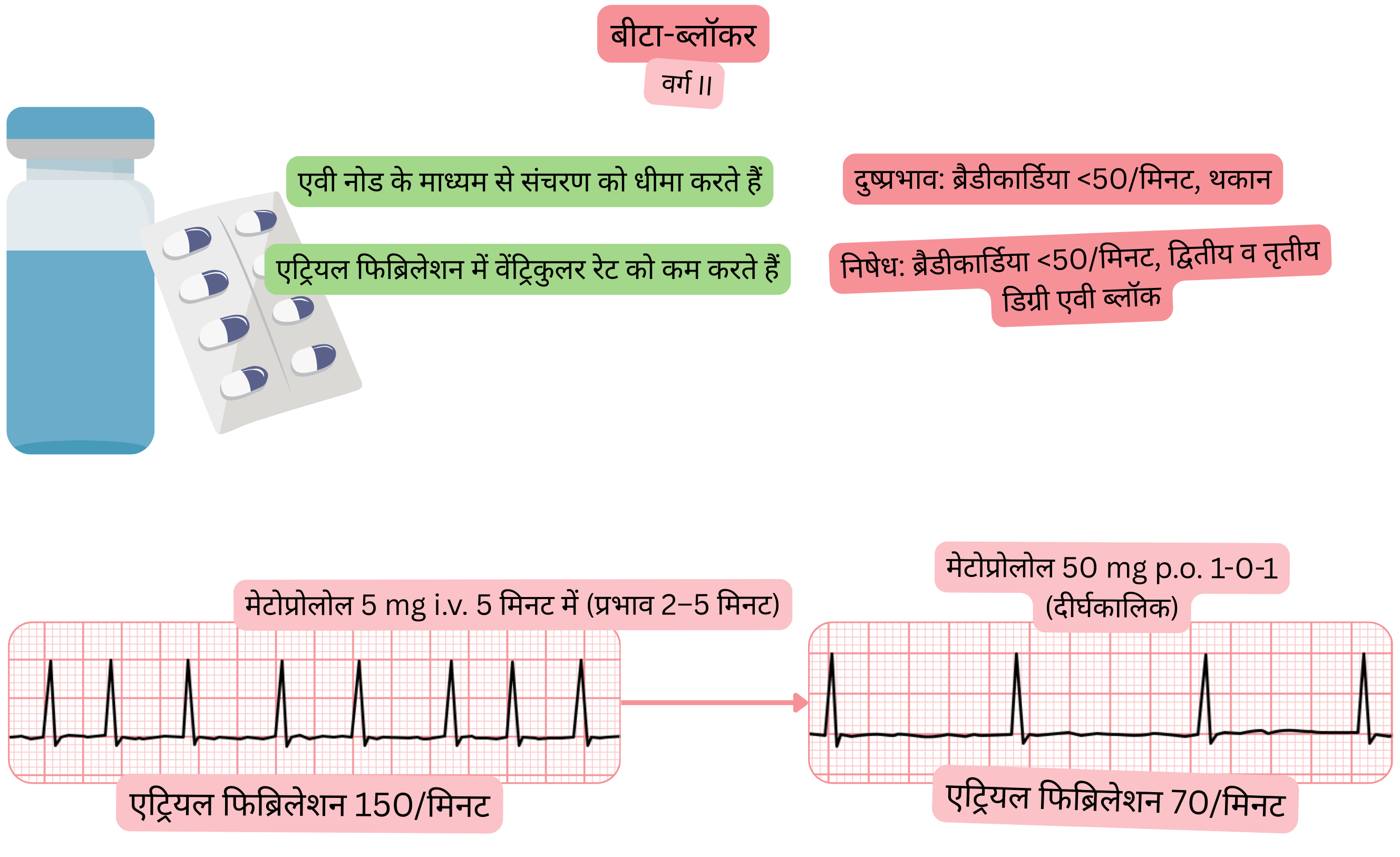 क्लास II एंटीएरिदमिक के रूप में बीटा-ब्लॉकर्स के प्रभाव का आरेख, जिसमें एट्रियोवेंट्रिकुलर नोड के माध्यम से संचरण के धीमे होने और एट्रियल फिब्रिलेशन में वेंट्रिकुलर प्रतिक्रिया में कमी को दर्शाया गया है।