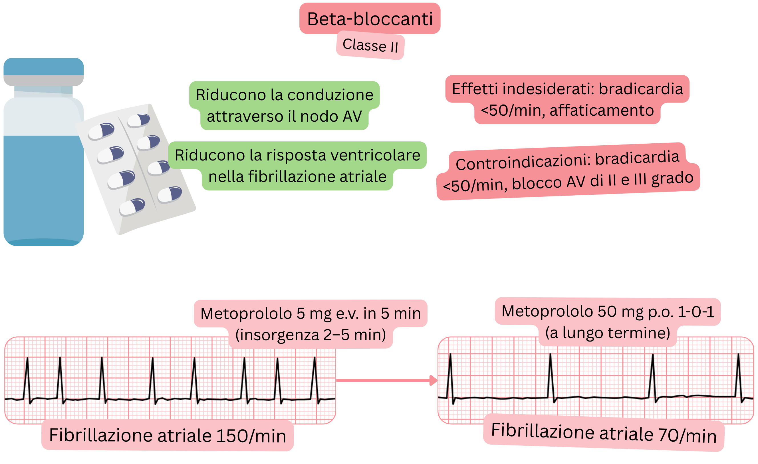 Schema dell’effetto dei beta-bloccanti come antiaritmici di classe II che illustra il rallentamento della conduzione attraverso il nodo atrioventricolare e la riduzione della risposta ventricolare nella fibrillazione atriale.