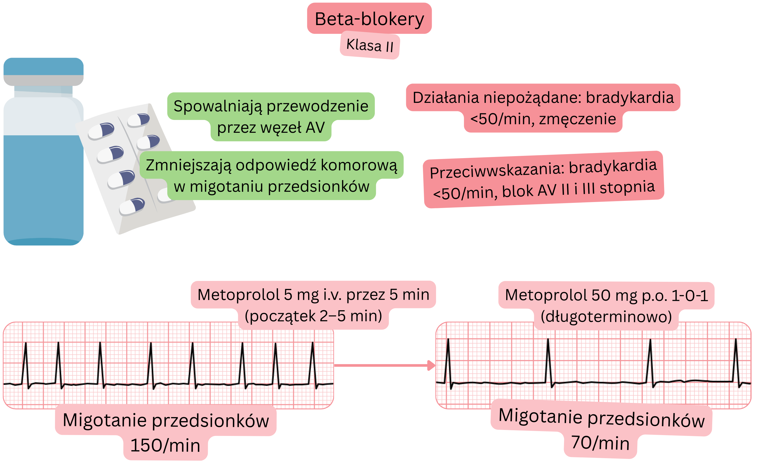 Schemat działania beta-adrenolityków jako leków antyarytmicznych klasy II, przedstawiający spowolnienie przewodzenia przez węzeł przedsionkowo-komorowy oraz zmniejszenie odpowiedzi komorowej w migotaniu przedsionków.