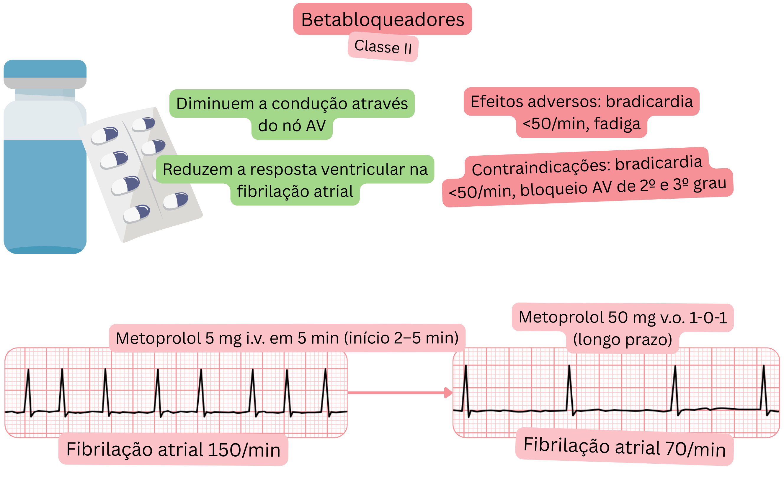 Esquema do efeito dos betabloqueadores como antiarrítmicos de classe II demonstrando lentificação da condução pelo nó atrioventricular e redução da resposta ventricular na fibrilação atrial.