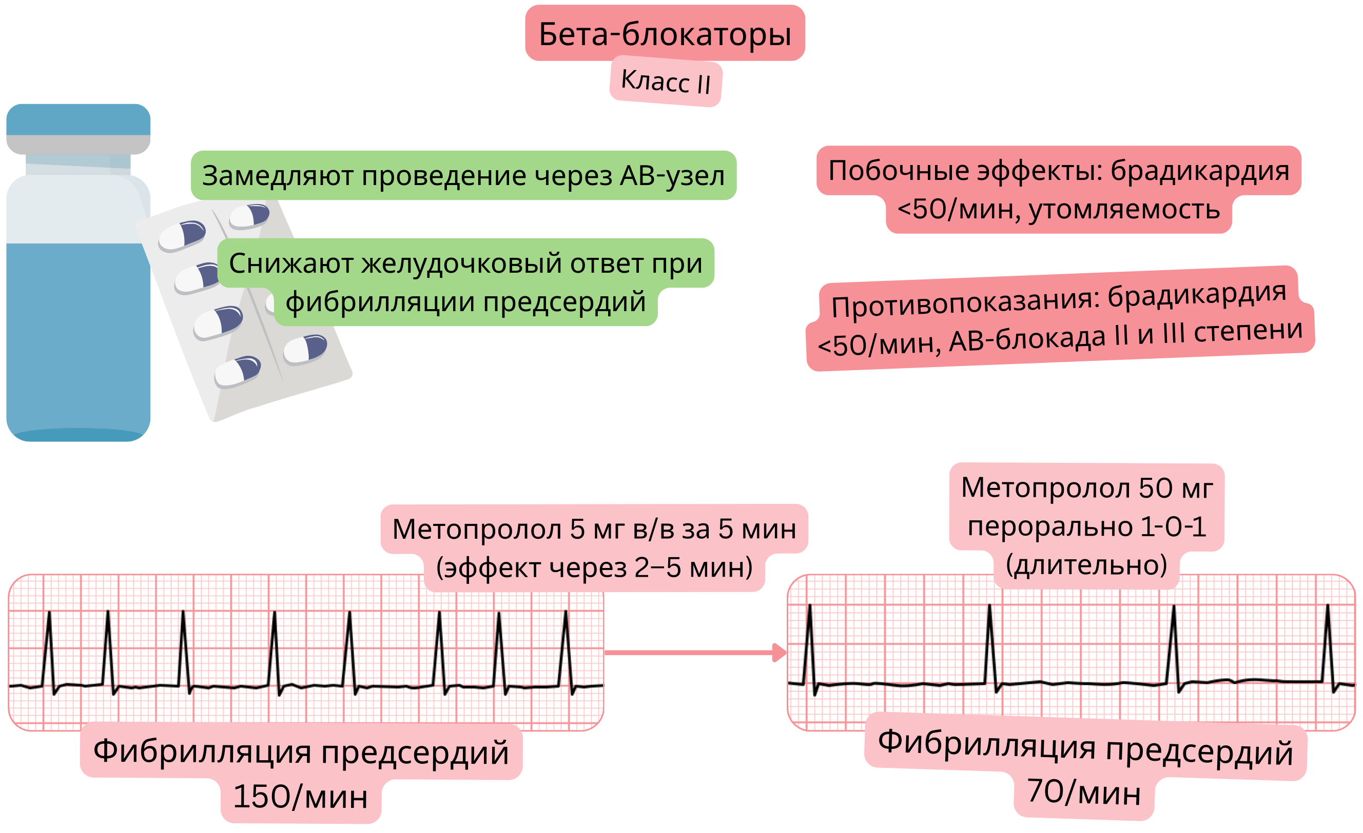 Схема действия бета-блокаторов как антиаритмических препаратов класса II, демонстрирующая замедление проведения через атриовентрикулярный узел и снижение желудочкового ответа при фибрилляции предсердий.